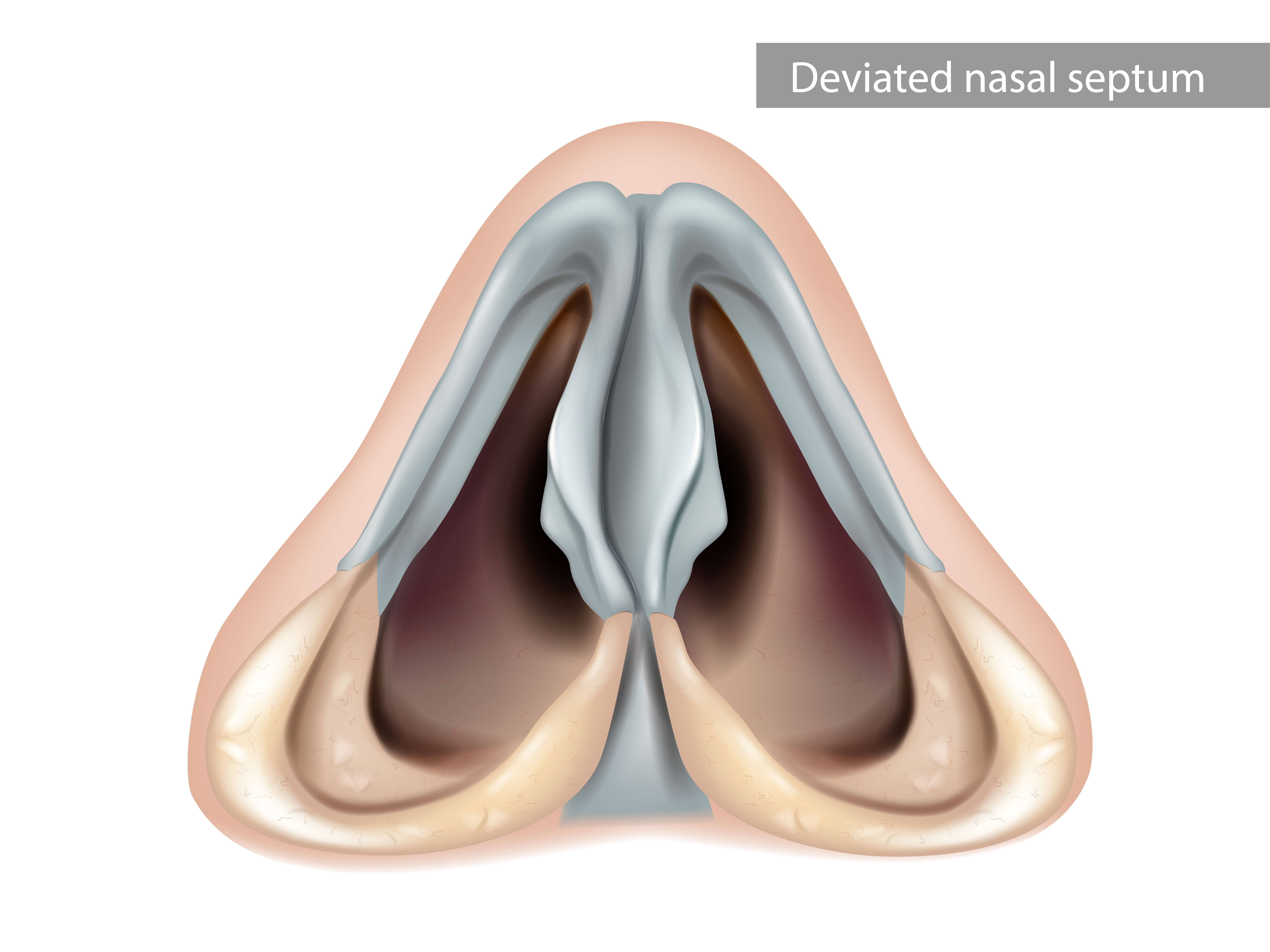 Cloison nasale déviée : vue inférieure de la cavité nasale | Source : Getty images