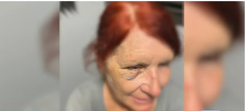 Donna Hansbrough blessée à l'œil | Source : Youtube.com/WJCL News