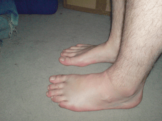 Une vue de l'inflammation du pied gauche d'un homme. | photo : Flickr