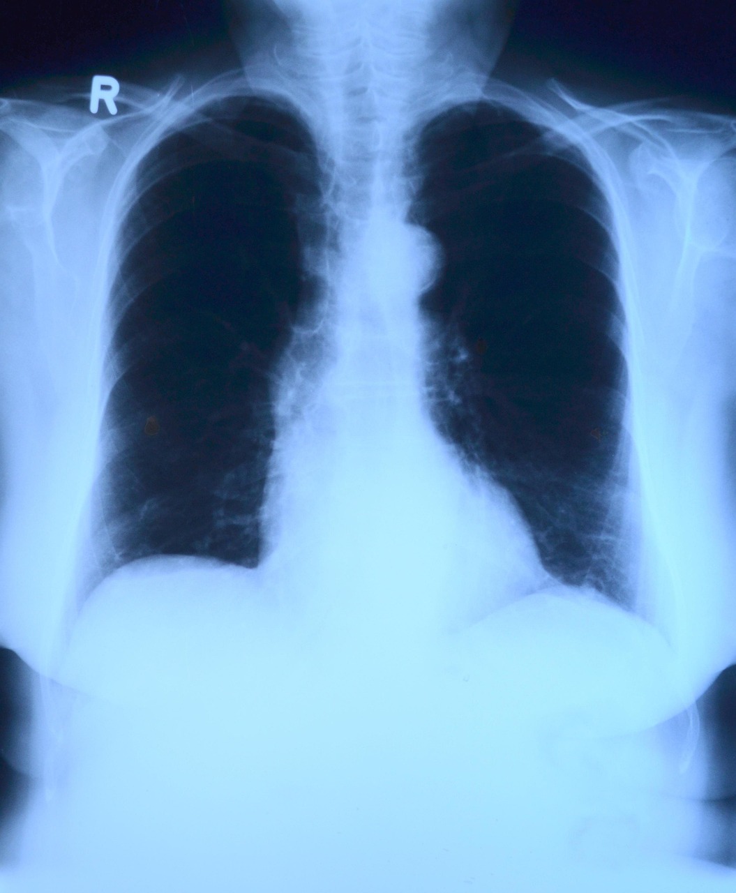Une radiographie des poumons | Source : Pixabay
