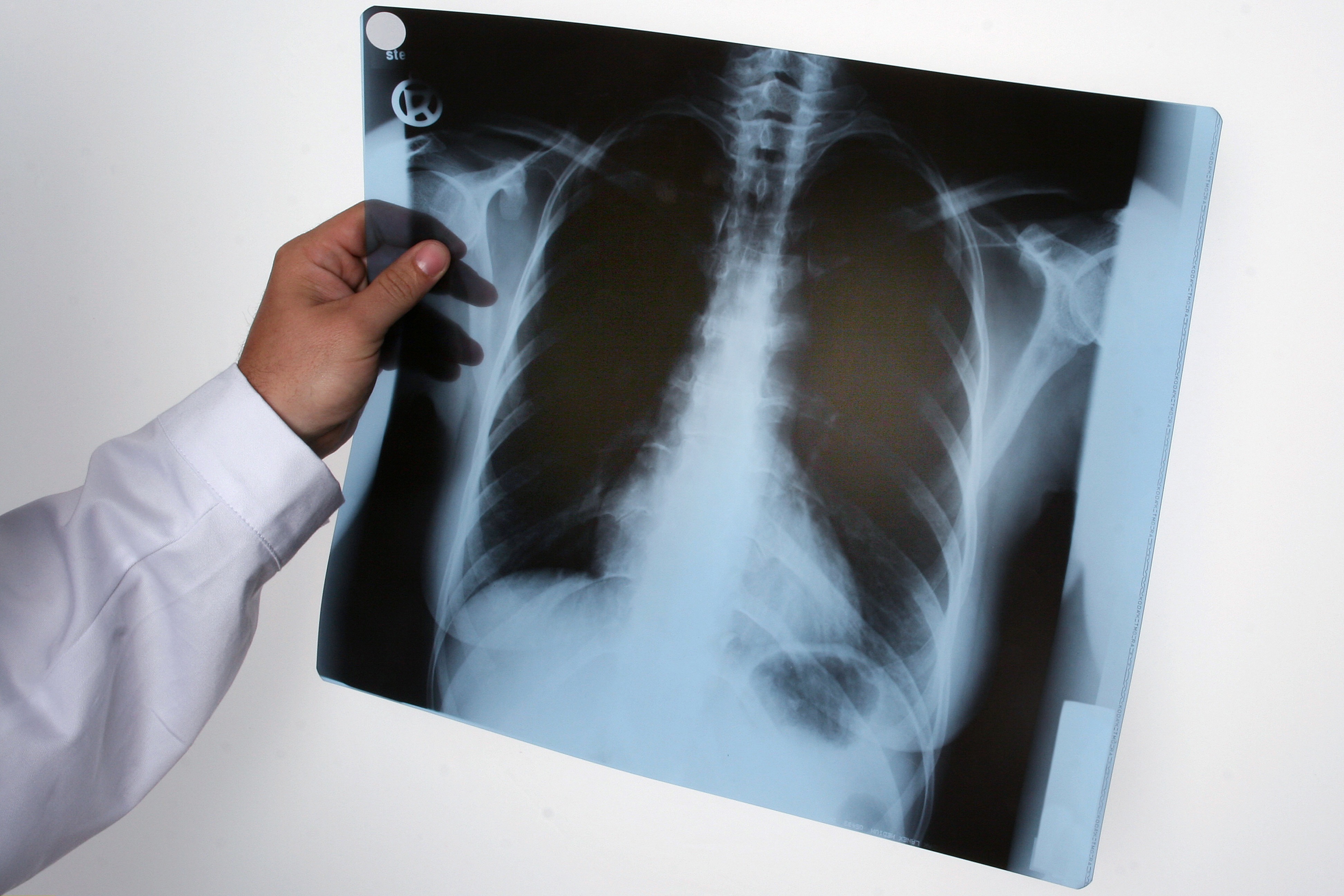 Un médecin examine une radiographie des poumons | Source : Getty Images