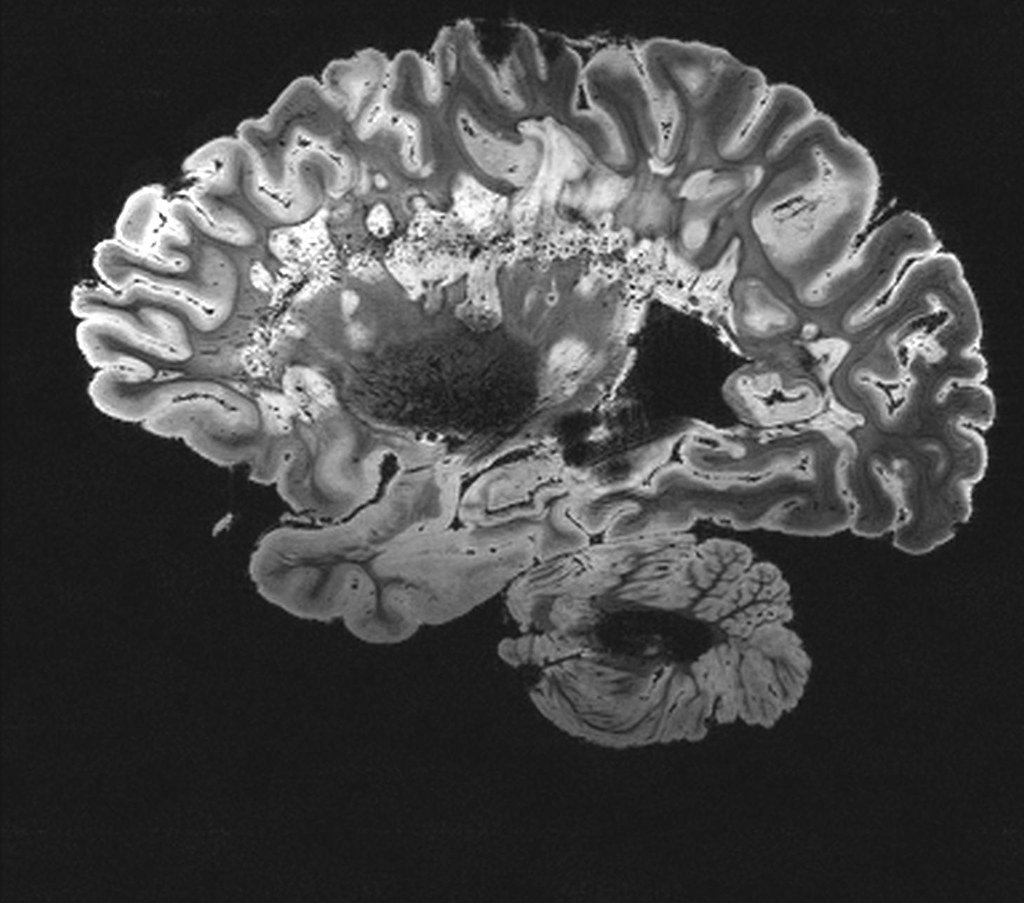 Imagerie par résonance magnétique du cerveau. | Photo : Flickr