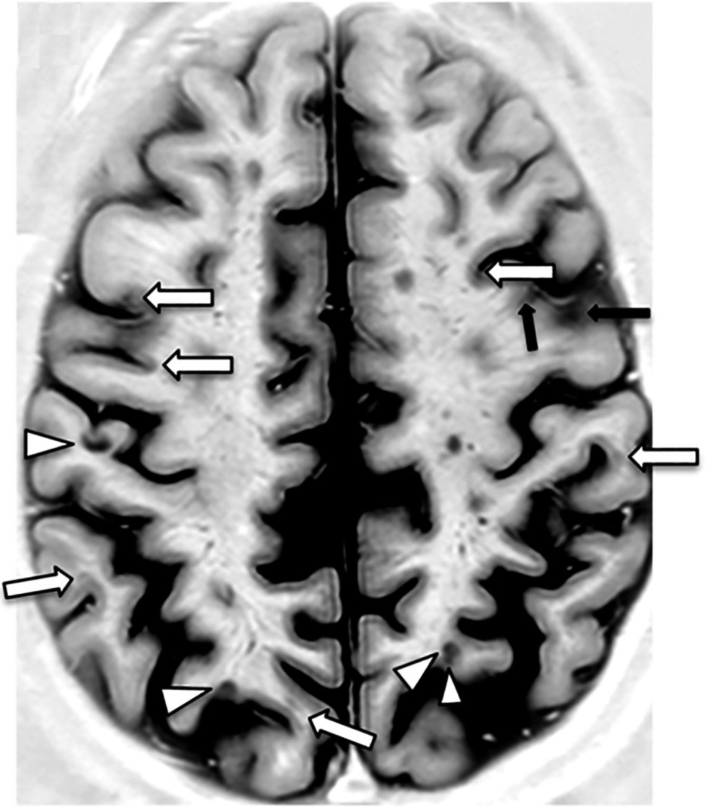 Imagerie par résonance magnétique du cerveau. | Photo : Wikimedia Commons