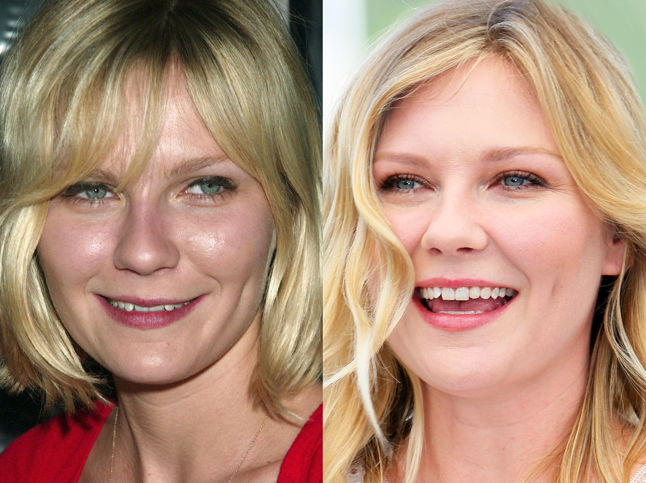 Avant et après du sourire de Kirsten Dunst. | Source : Getty Images