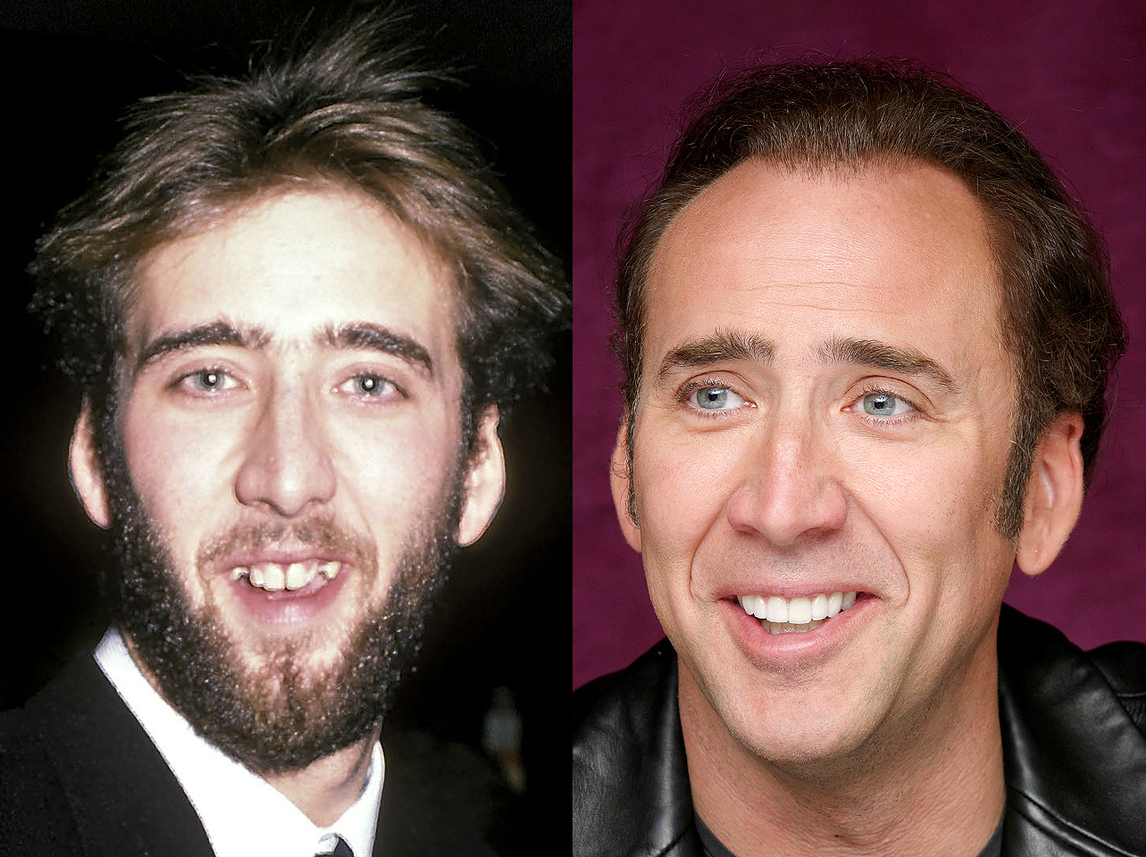 Avant et après du sourire de Nicolas Cage. | Source : Getty Images