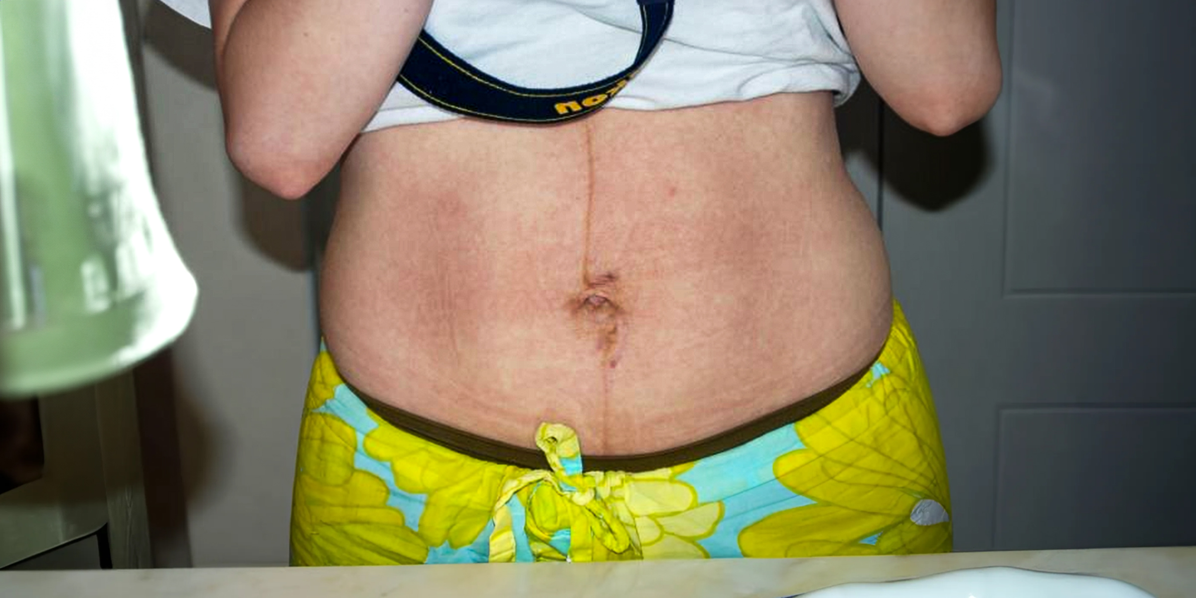 Le ventre d'une femme avec des vergetures | Source : Flickr