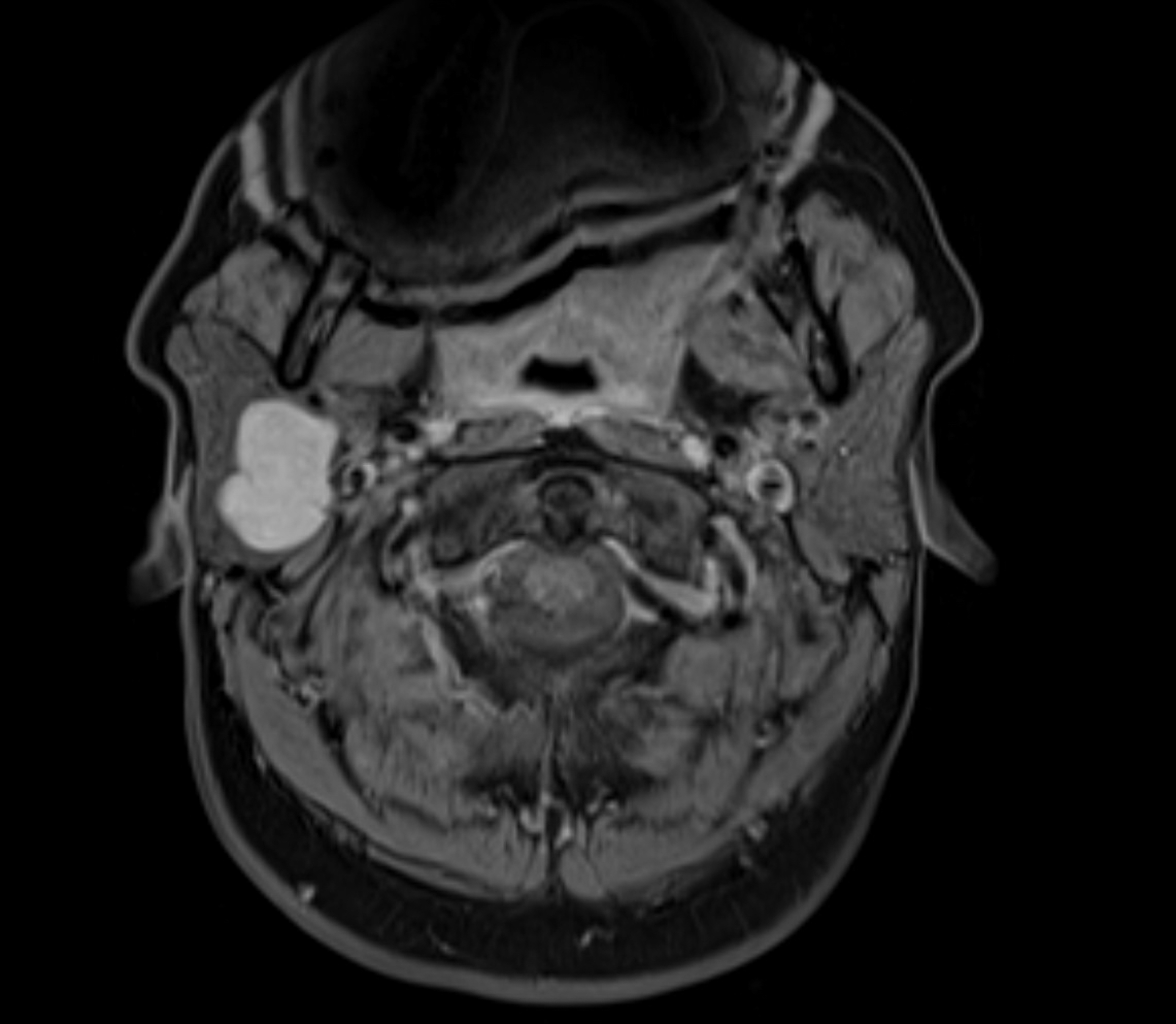 IRM multiparamétrique axiale montrant une tumeur de la glande parotide | Source : Getty Images