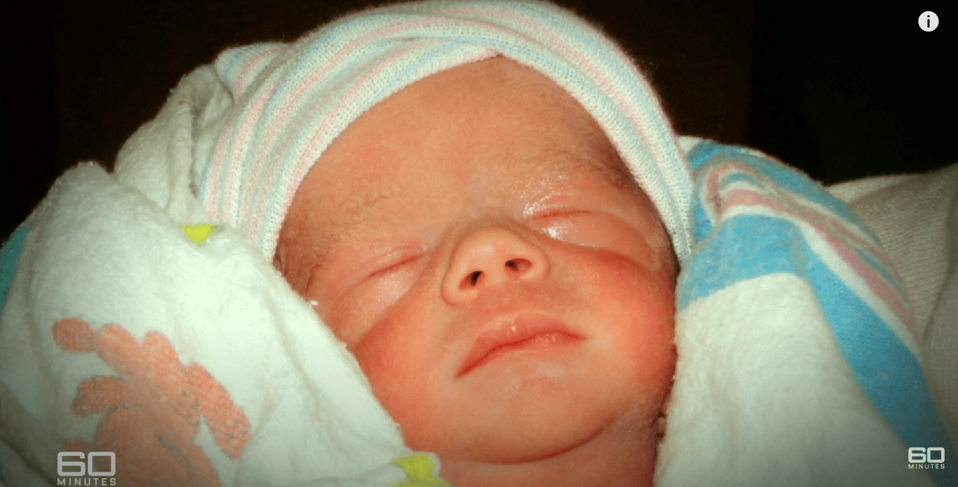 Bébé Logan après sa naissance | Source : youtube.com/60 Minutes Australia