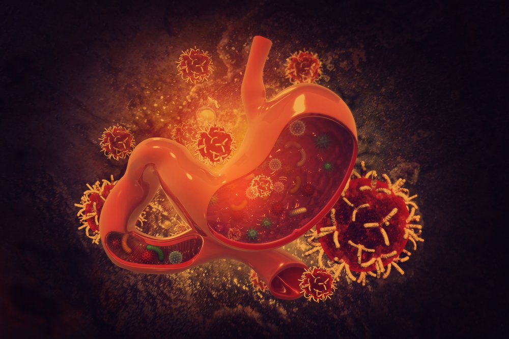 Un cancer de l'estomac. l Source: Shutterstock
