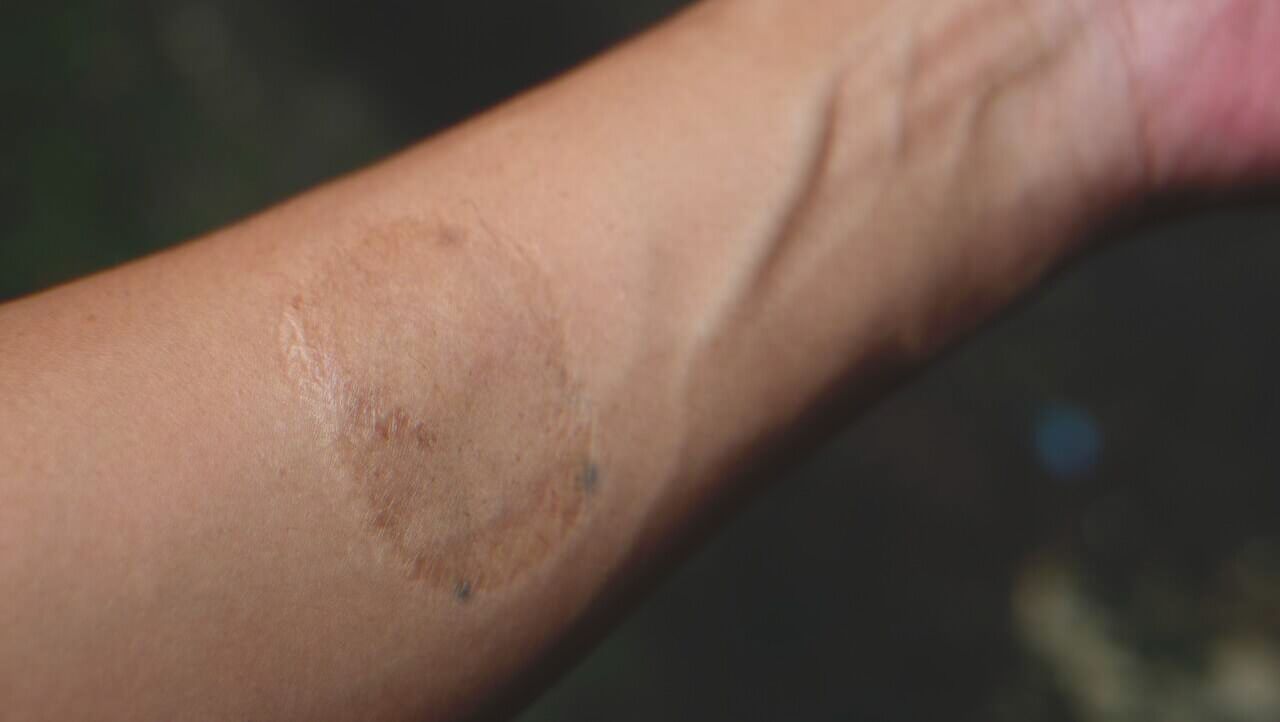 Une cicatrice de forme ovale sur la main d'une femme | Source : Shutterstock