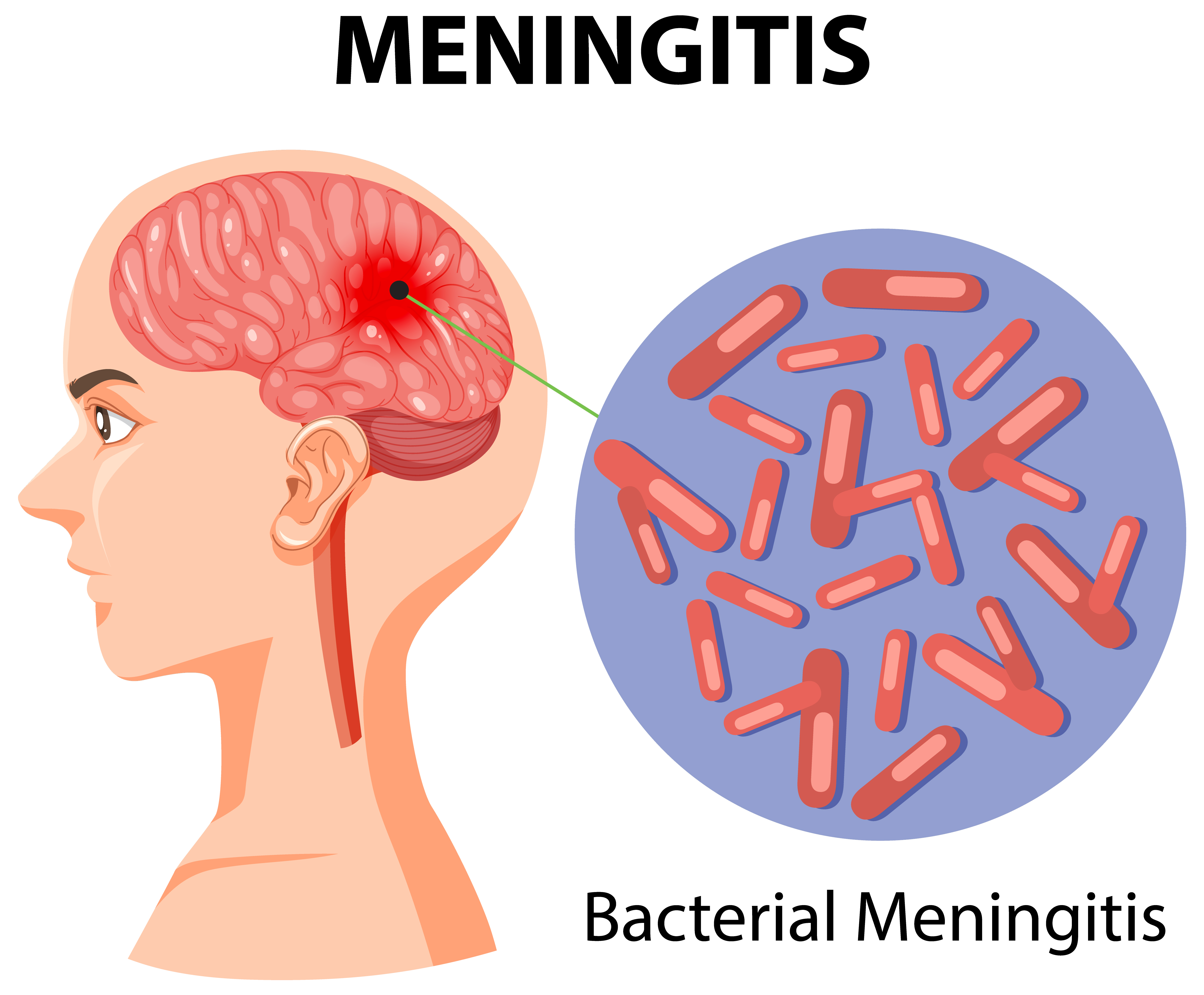 Image montrant un cerveau infecté par la méningite | Source : Getty images