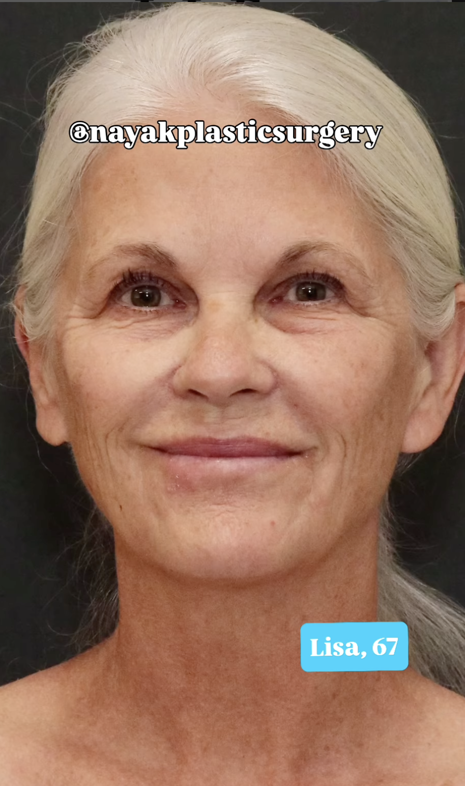 Lisa avant la chirurgie plastique, datée du 1er juin 2025 | Source : Instagram/nayakplasticsurgery