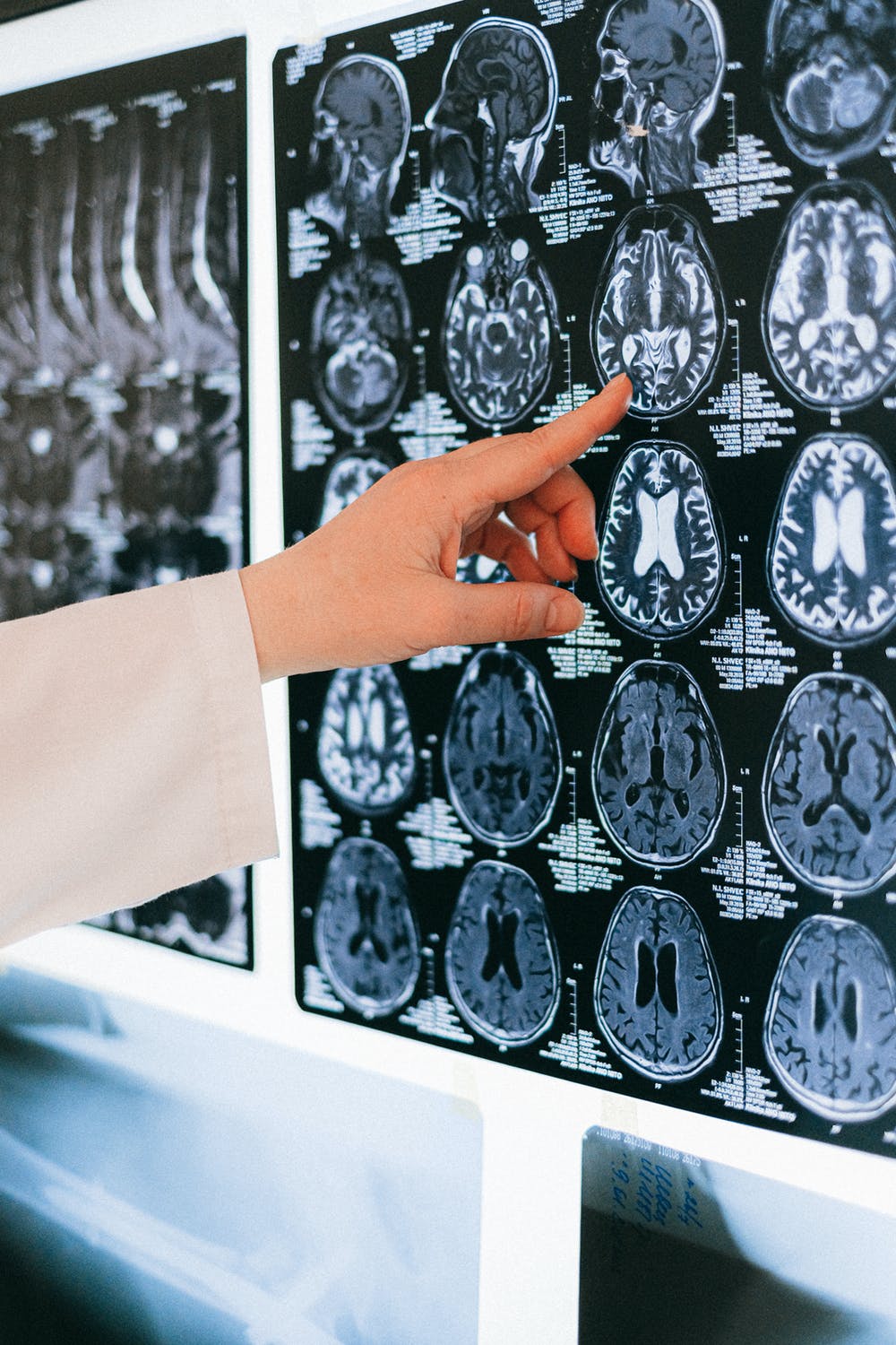 Le médecin a expliqué à Jessica que son mari avait une tumeur au cerveau | Source : Pexels