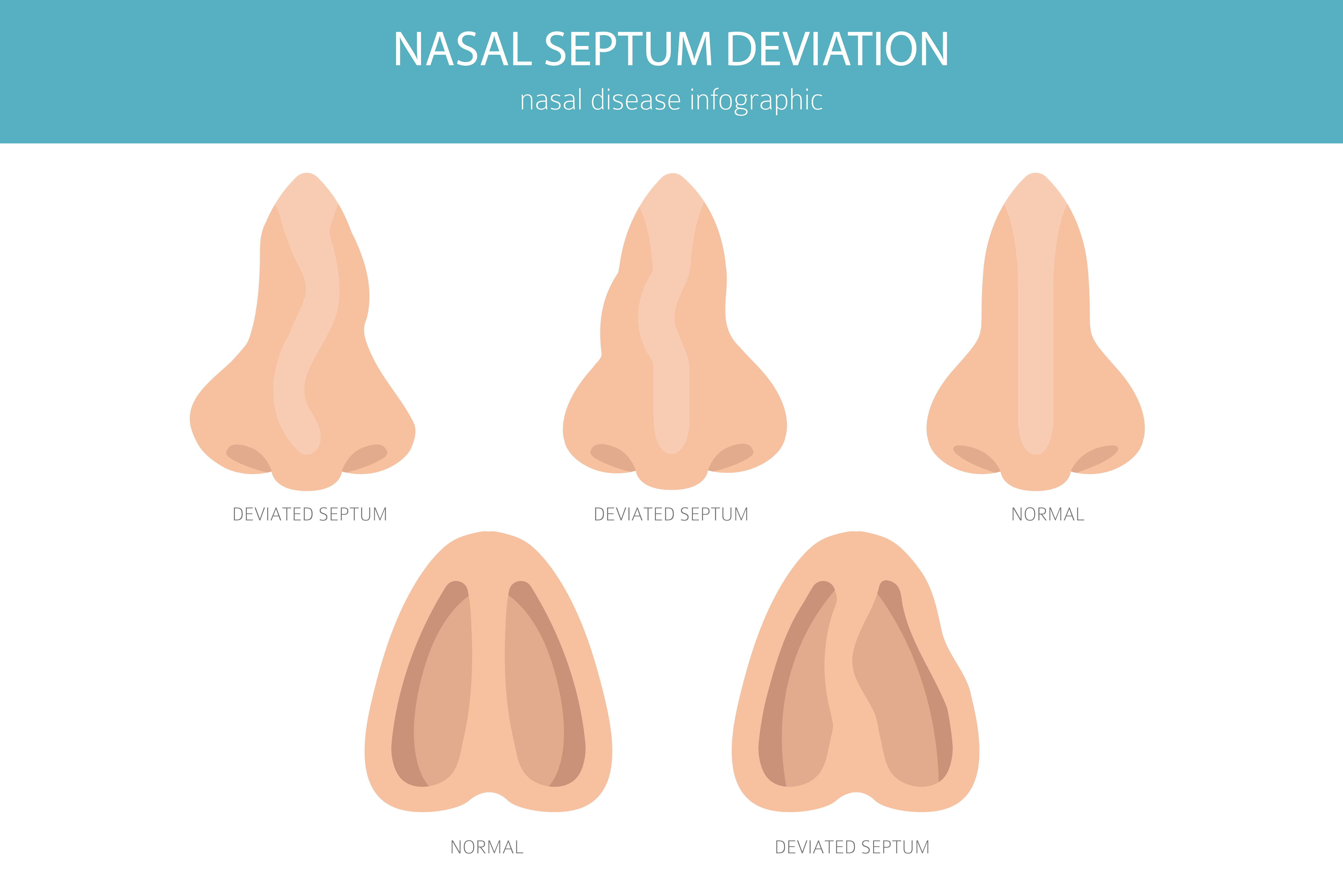 Illustration vectorielle d'un nez avec une cloison nasale déviée | Source : Getty Images