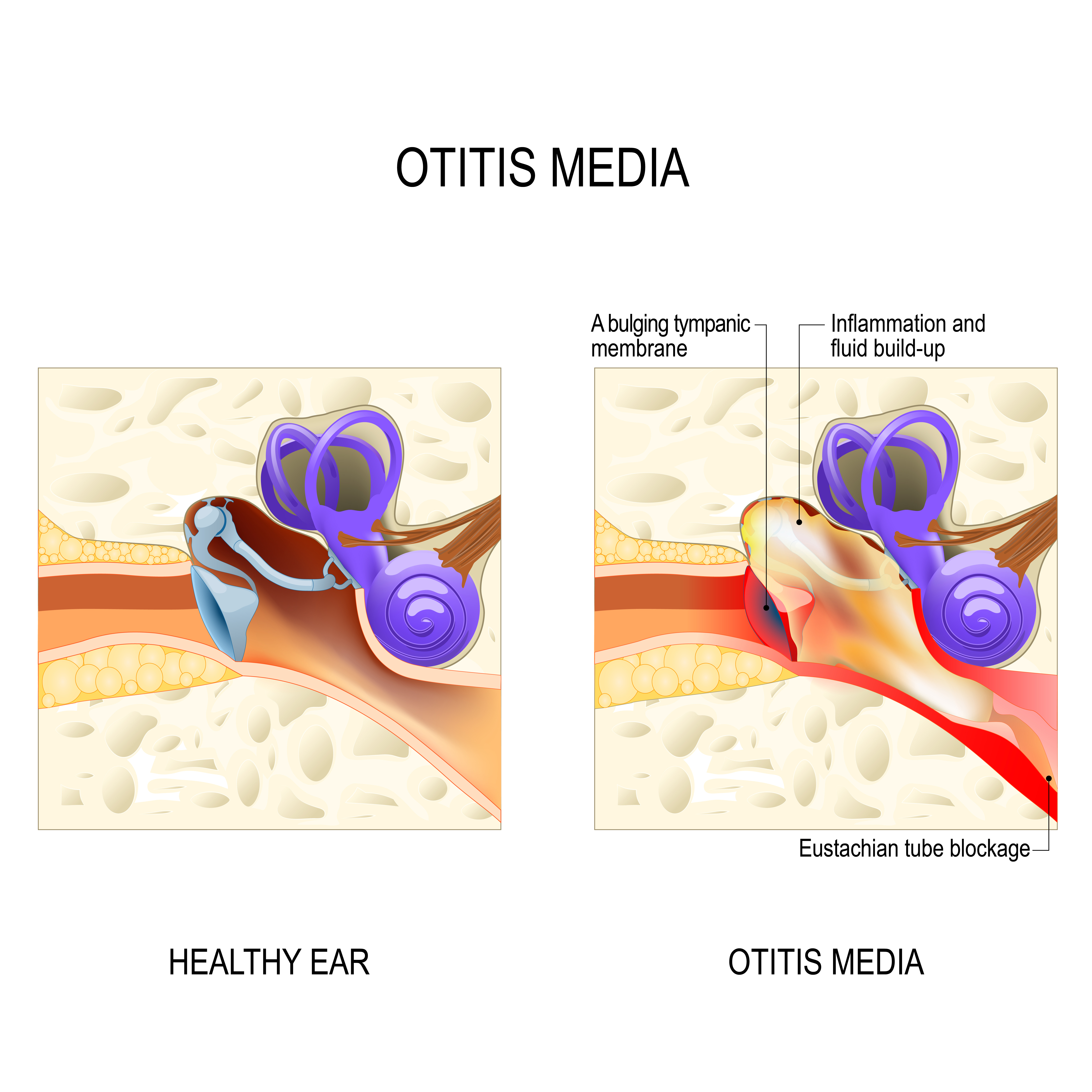 Illustration comparant une oreille saine à une oreille atteinte d'otite moyenne, une affection provoquant une inflammation et une accumulation de liquide dans l'oreille | Source : Getty Images