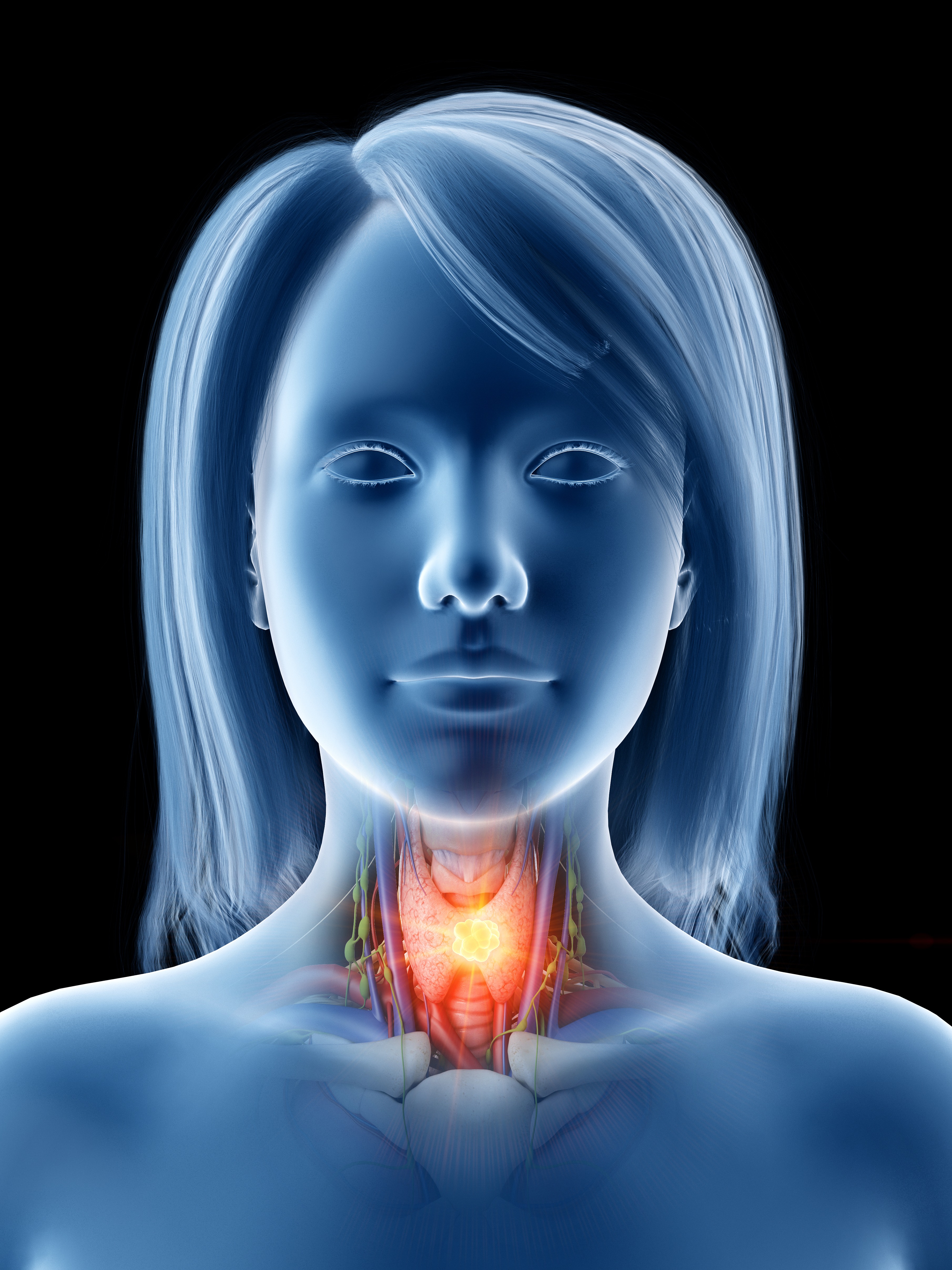 Visualisation numérique d'un cancer de la thyroïde montrant la glande atteinte et les structures anatomiques voisines | Source : Getty Images