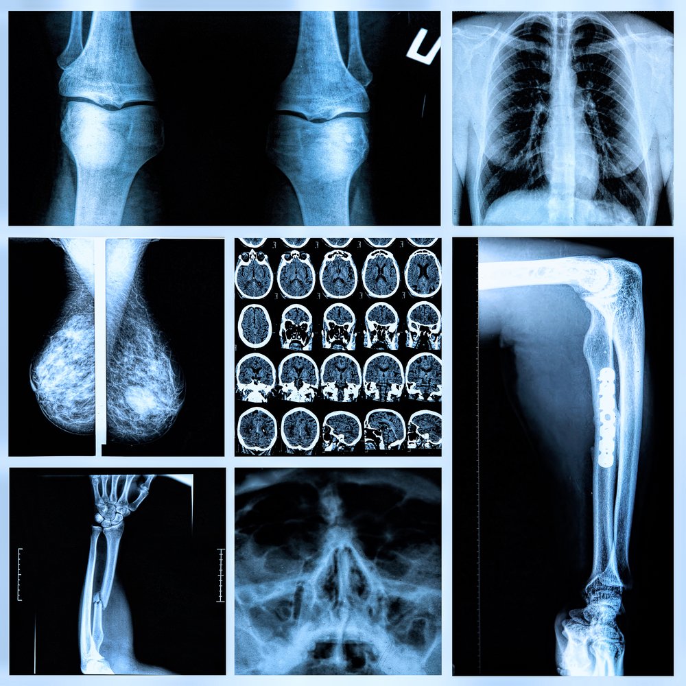 Radiographie osseuse. | Photo : Shutterstock