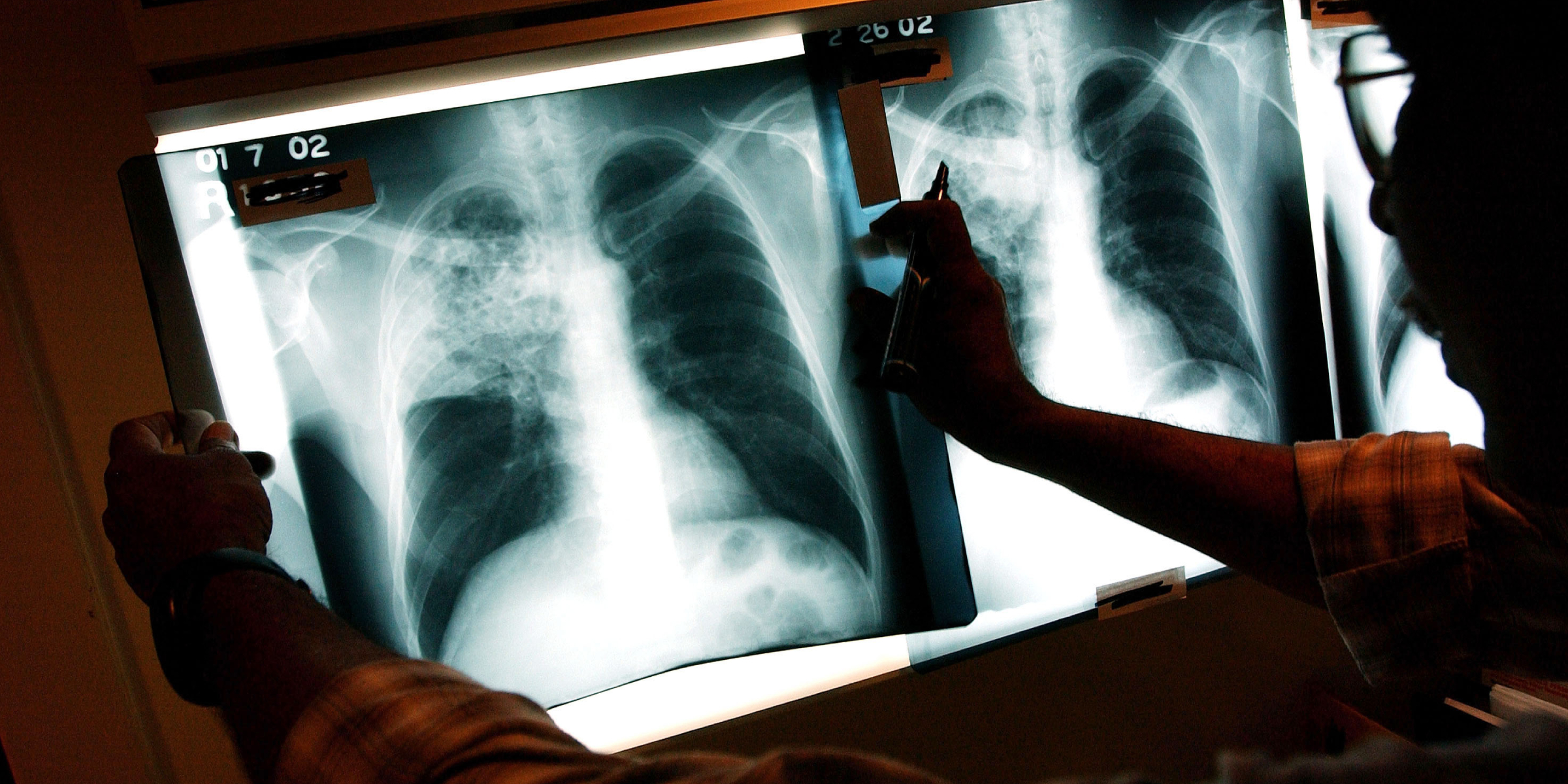 Un médecin examine les radiographies d'un patient atteint de tuberculose | Source : Getty Images