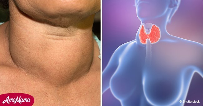 Les 4 premiers signes cachés d'un cancer de la thyroïde que beaucoup de personnes ignorent, selon un médecin