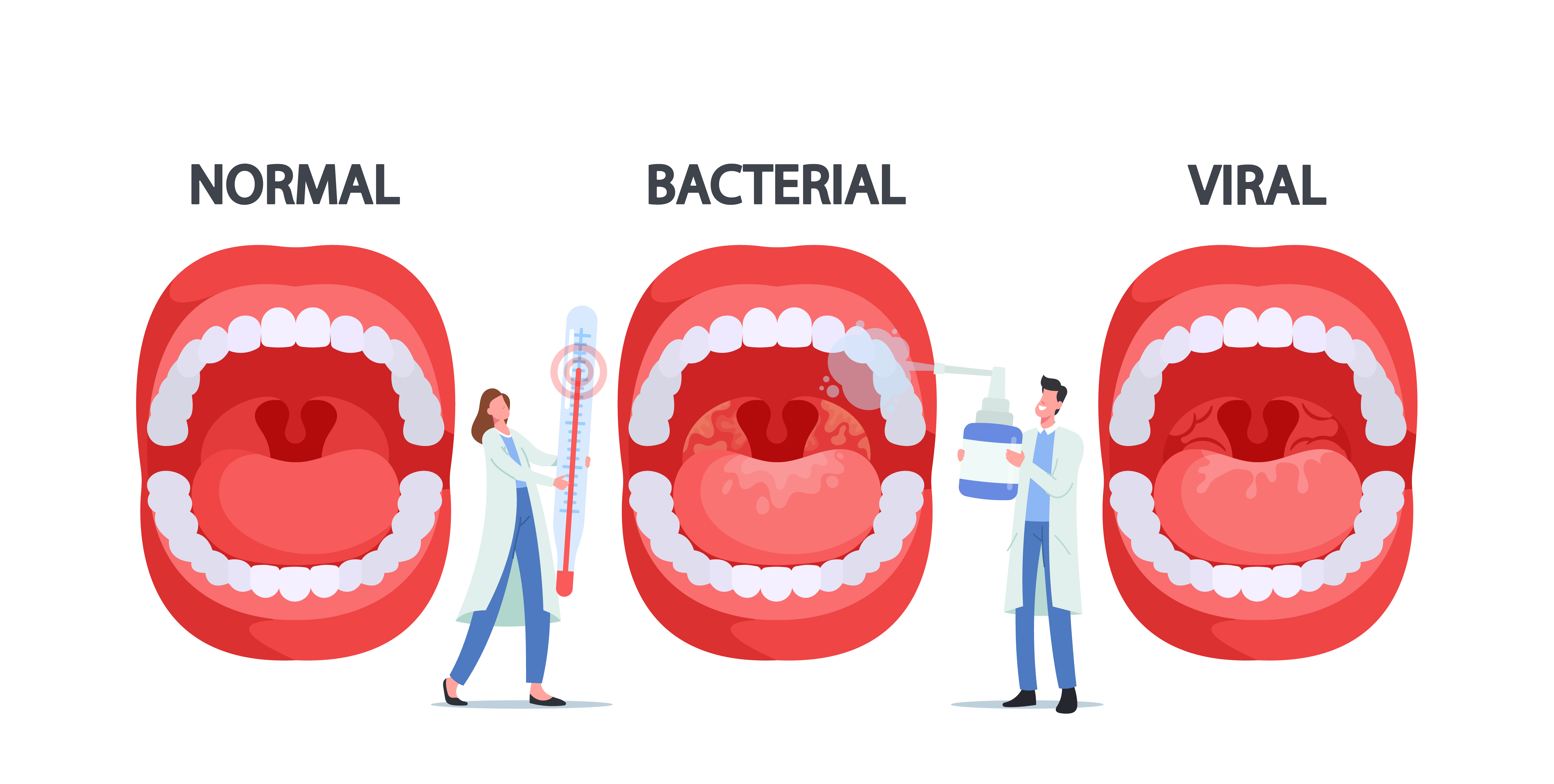 Illustration vectorielle montrant une infection de l'amygdale par la bactérie Streptococcus Thermophilus | Source : Getty images