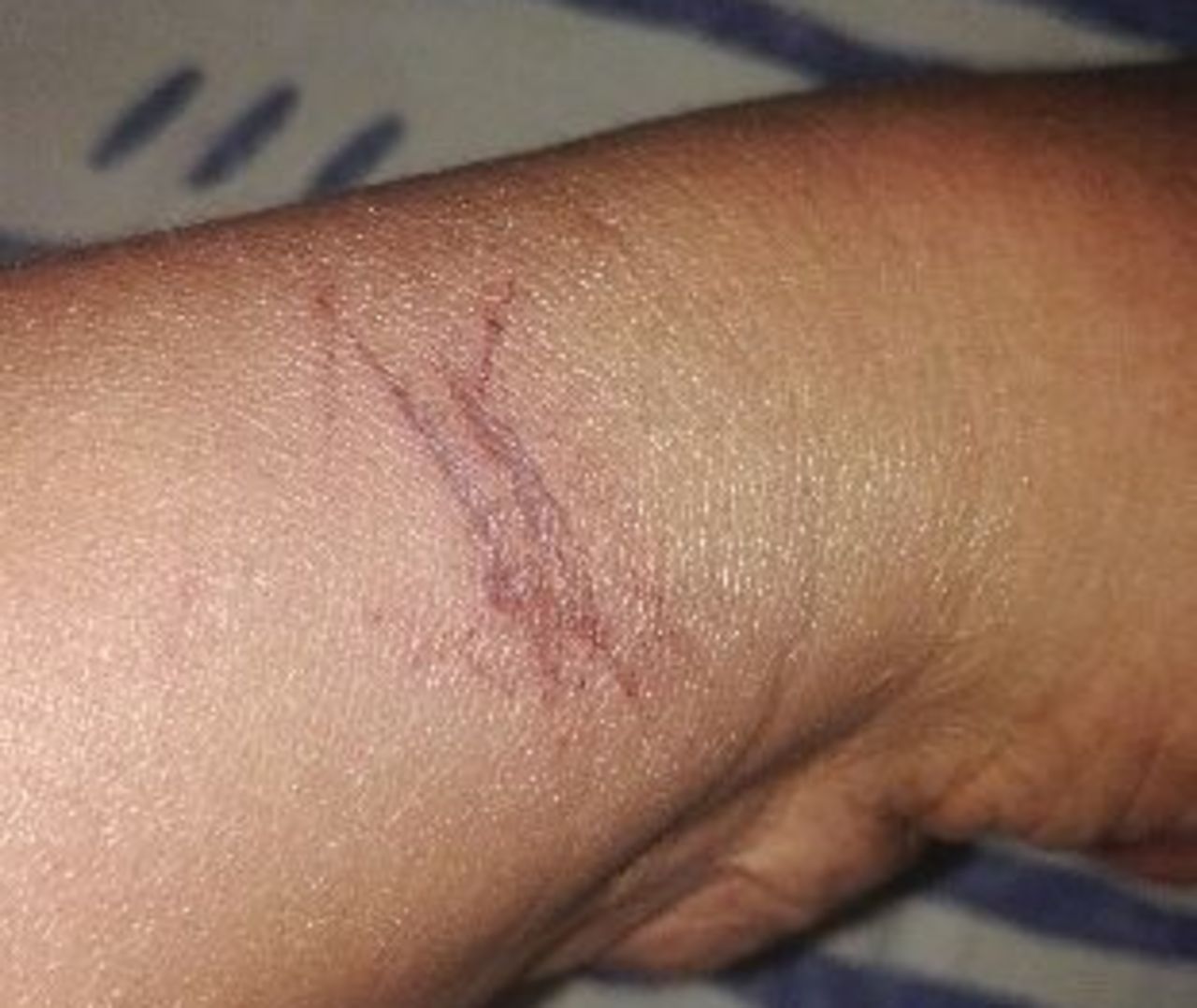 Quelques jours après les faits, l’étreinte des menottes sur le poignet de Mireille était toujours visible. | LP/F.L.