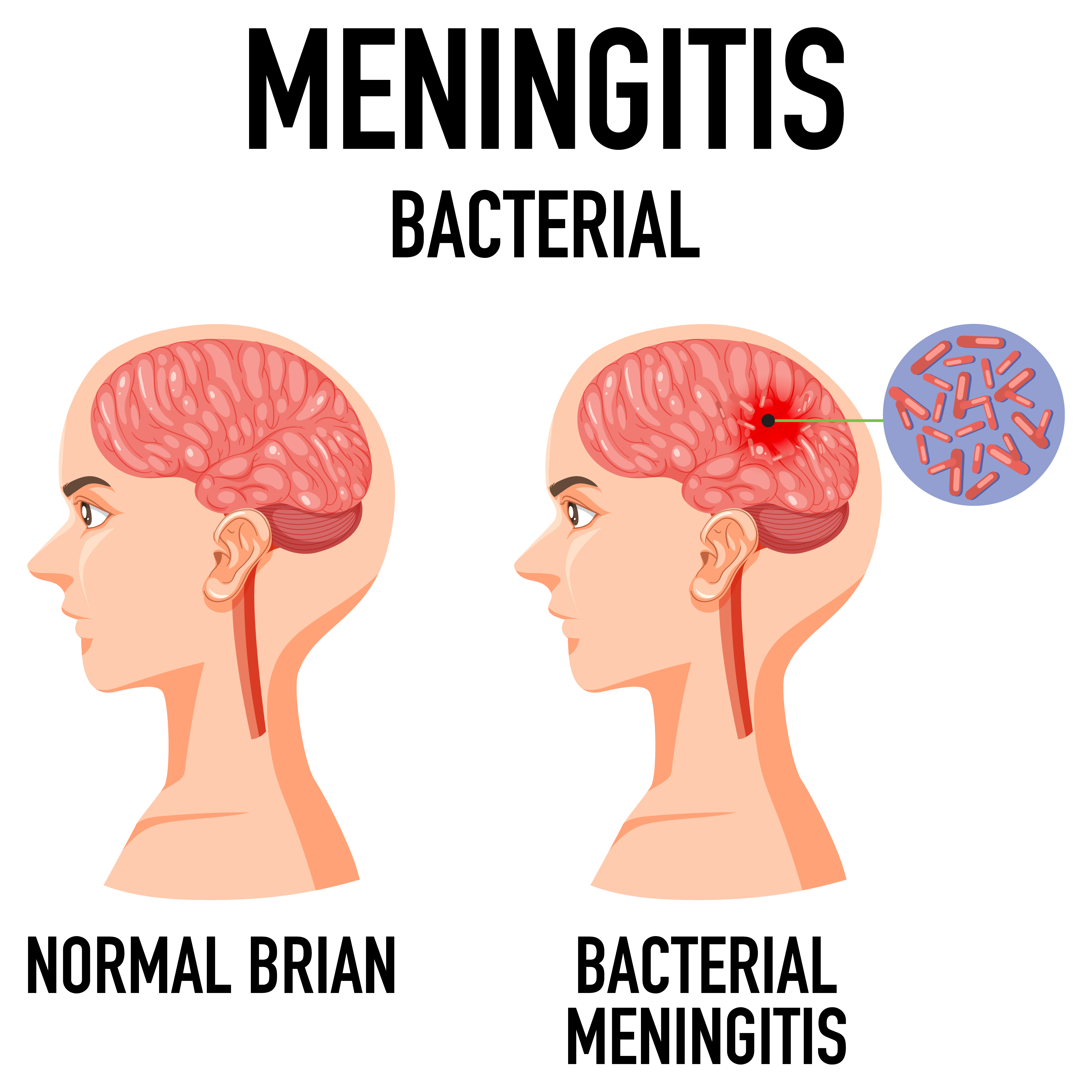Diagramme montrant une méningite bactérienne | Source : Getty images