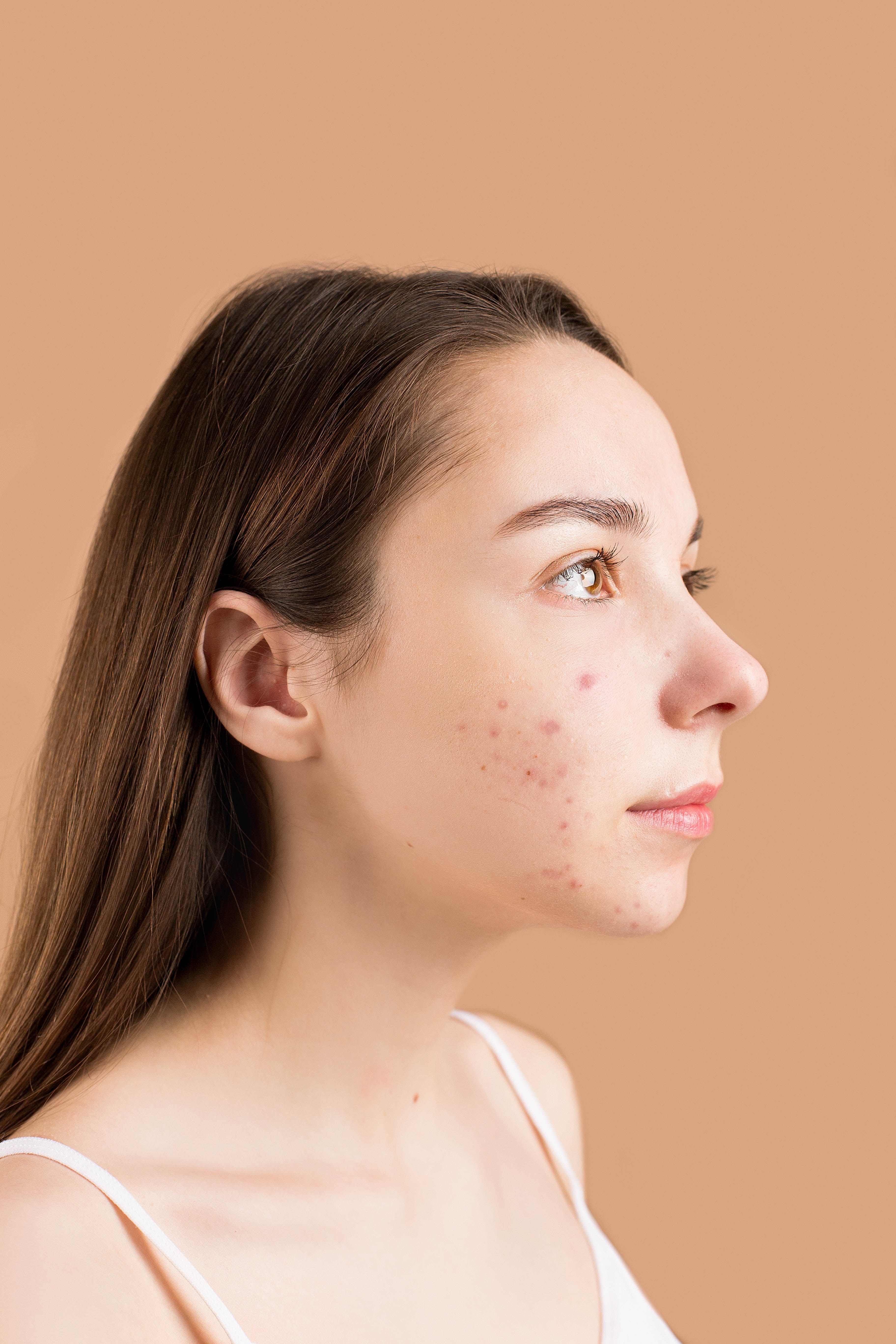 Une femme avec de l'acné | Source : Pexels