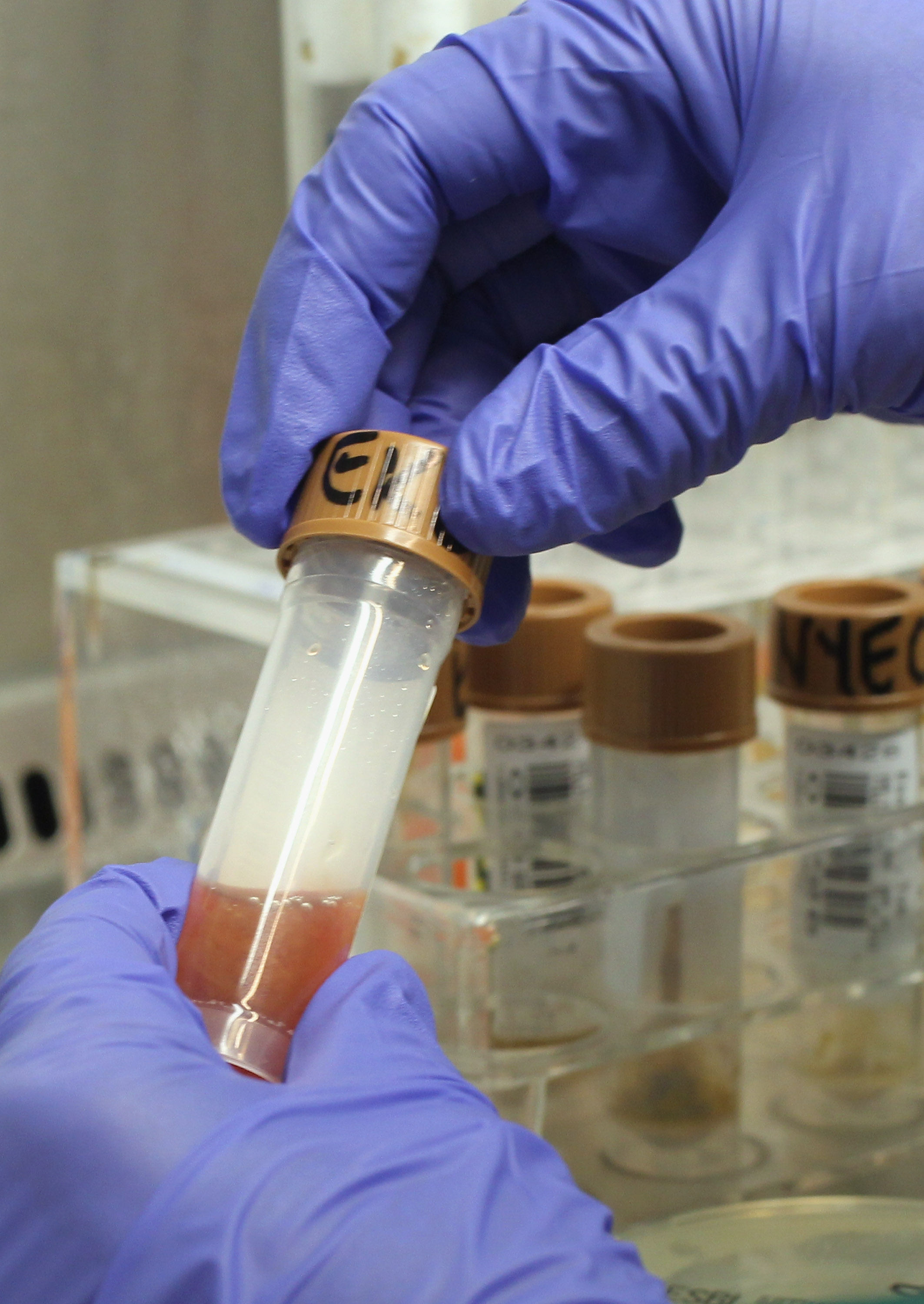 Un technicien de laboratoire ouvre un échantillon de selles ensanglantées prélevé sur un patient | Source : Getty Images