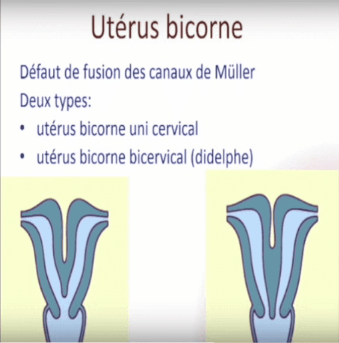 Coupes d'un utrus bicorne uni-cervical et d'un autre bicorne bi-cervical (didelphe). | Youtube/Dr Ahmed SKHIRI