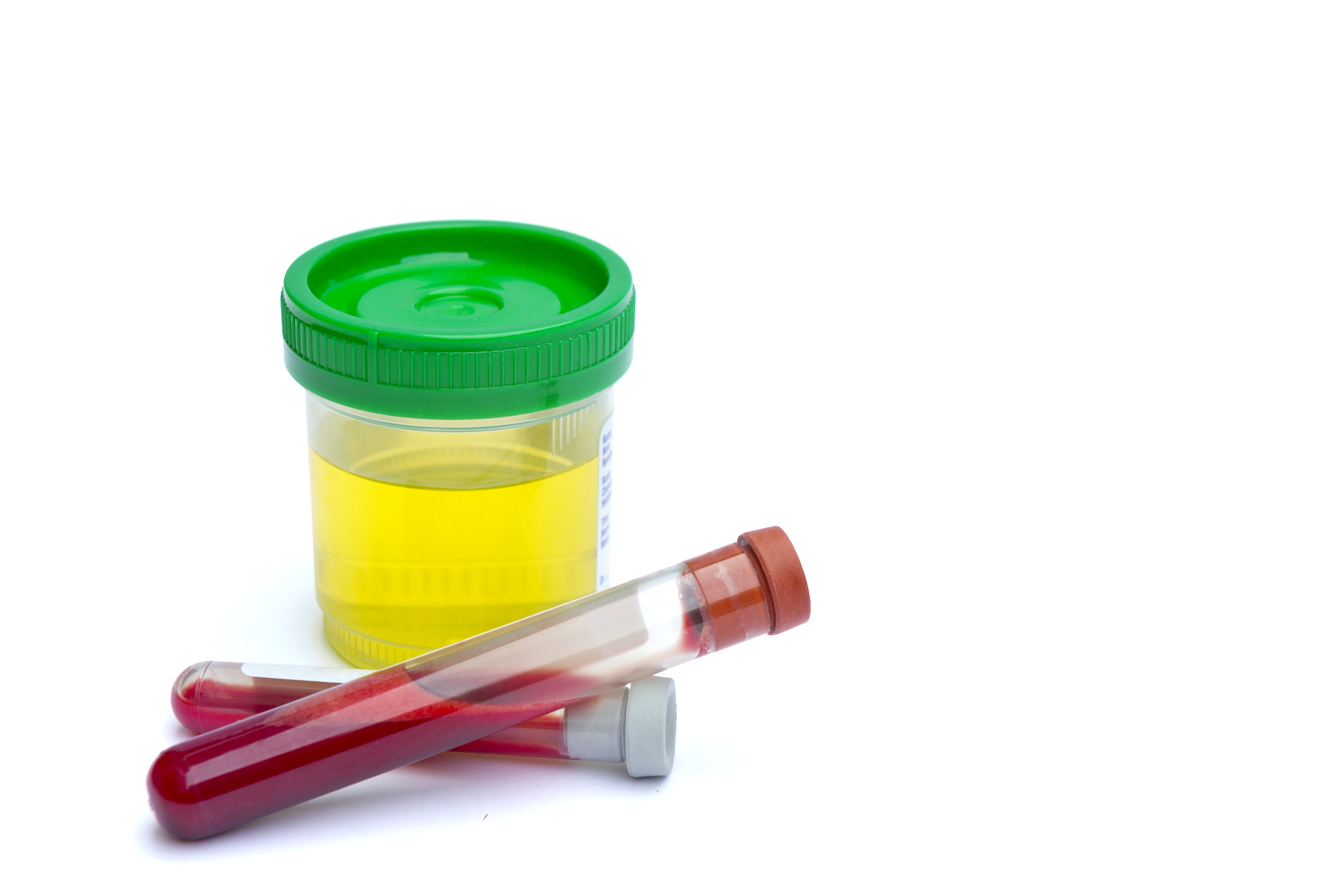 Flacons stériles pour les échantillons d'urine et les analyses de sang dans un environnement clinique | Source : Getty Images