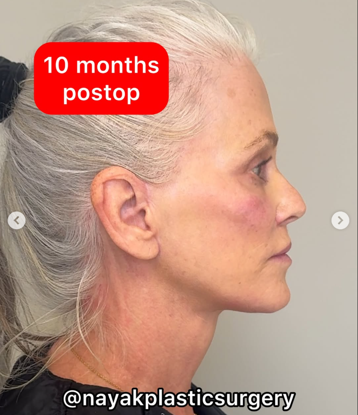 Lisa après l'opération, d'après un post daté du 4 avril 2025 | Source : Instagram/nayakplasticsurgery