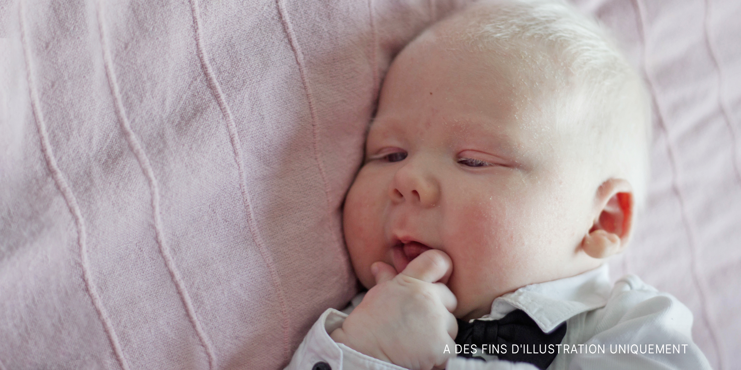 Un bébé atteint d'albinisme | Source : Shutterstock