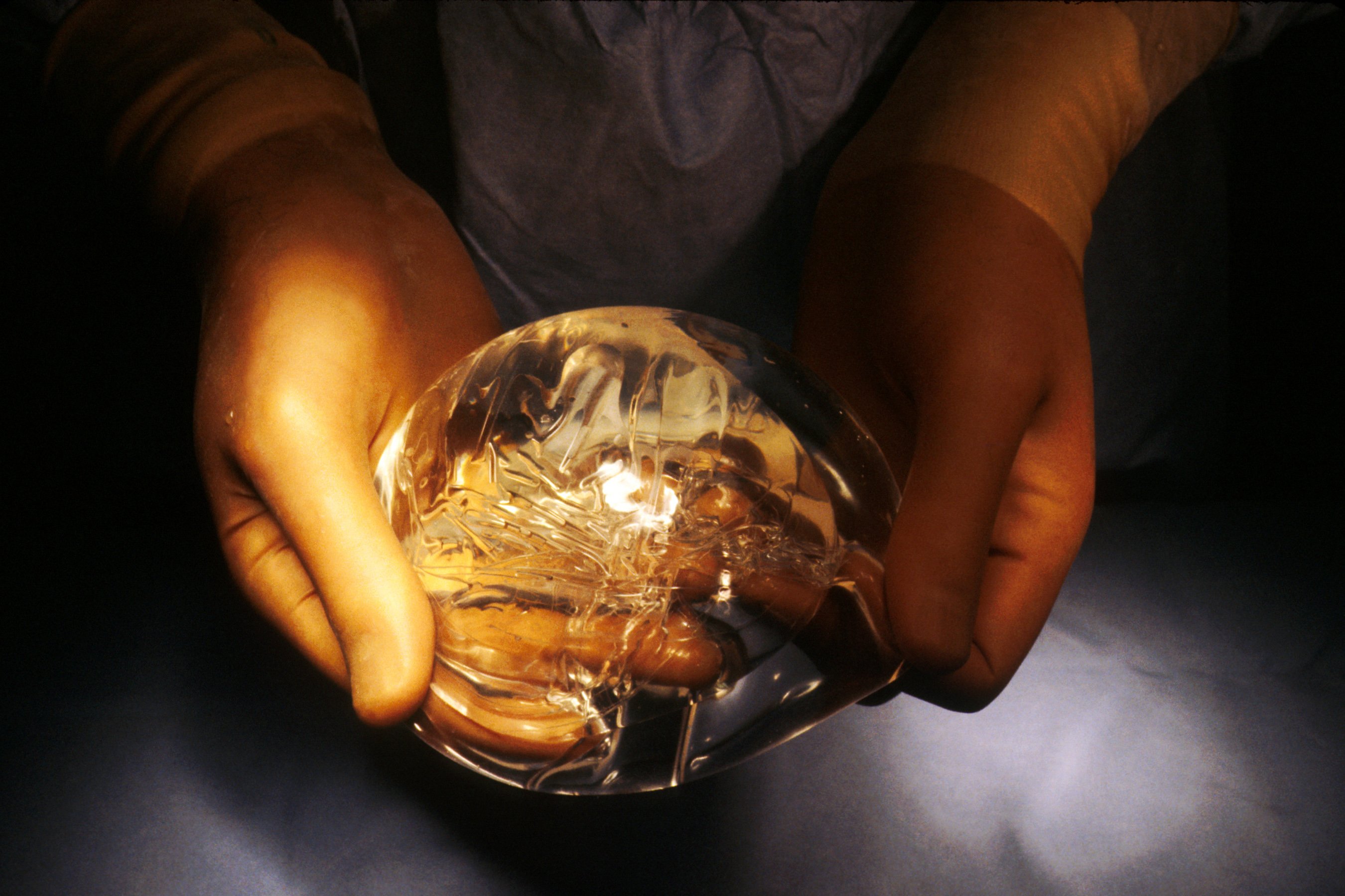Image de l'implant mammaire | Image : Wikimedia Commons