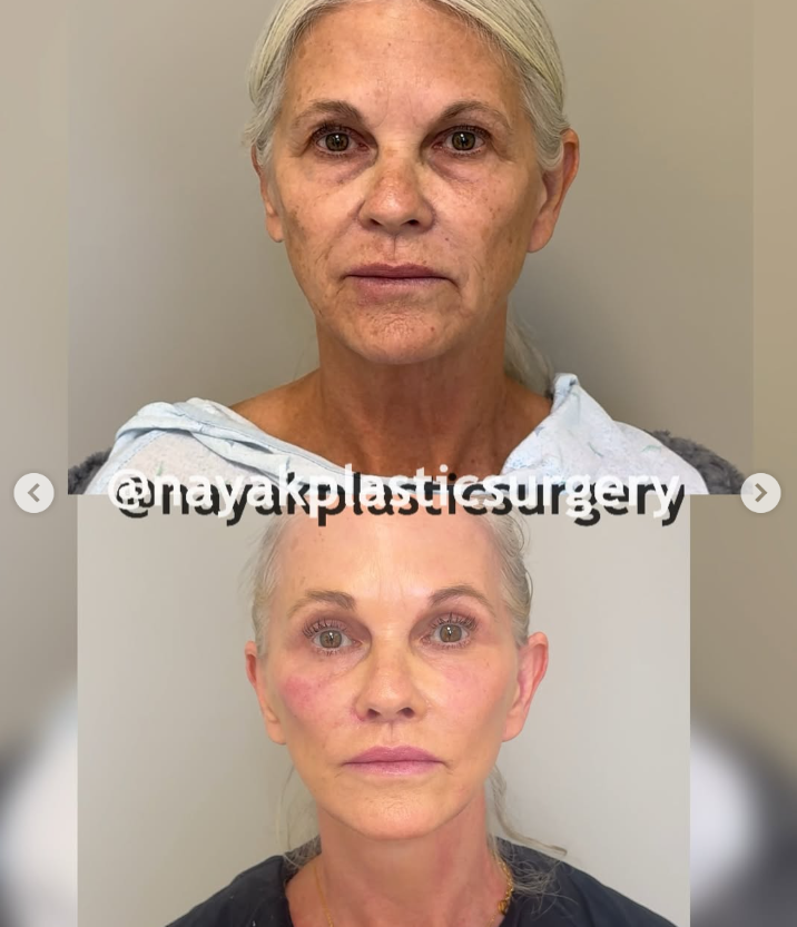 Les photos avant et après de Lisa, tirées d'un post daté du 4 avril 2025 | Source : Instagram/nayakplasticsurgery