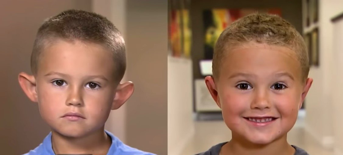 Photo de Gage Berger, six ans, avant et après l'opération. | Source : Youtube/Inside Edition