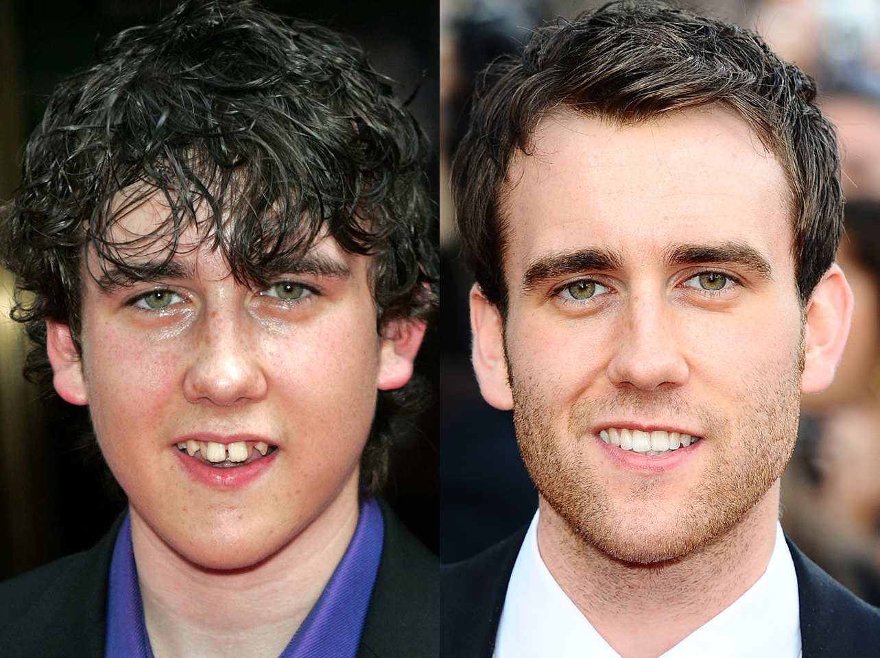 Un avant et un après du sourire de Matthew Lewis. | Source : Getty Images