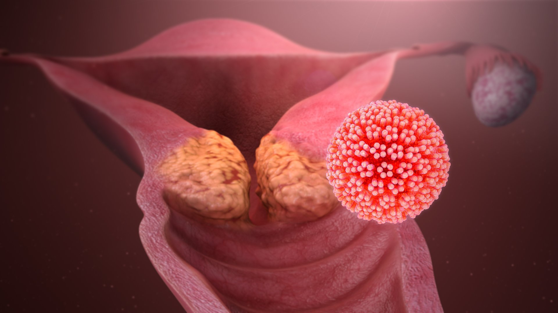 Cancer du col de l'utérus causé par le papillomavirus (VPH). l Source: Wikipedia