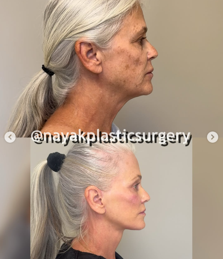 Les photos avant et après de Lisa, tirées d'un post daté du 4 avril 2025 | Source : Instagram/nayakplasticsurgery