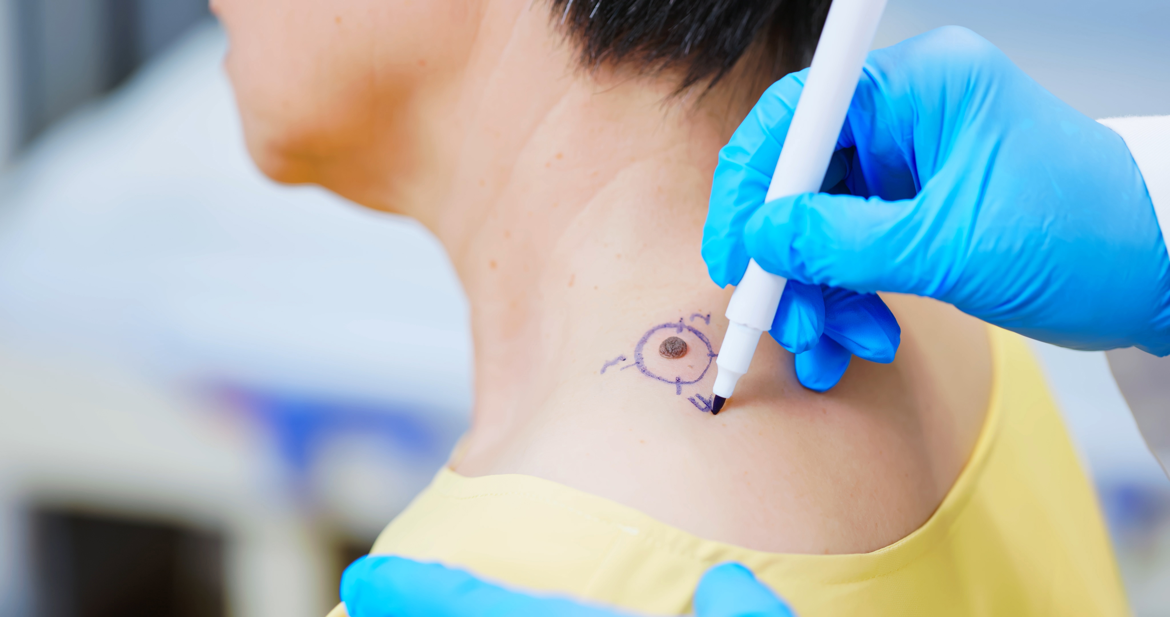 Gros plan sur le grain de beauté de l'épaule d'une femme, marqué pour être traité par un médecin | Source : Getty Images.