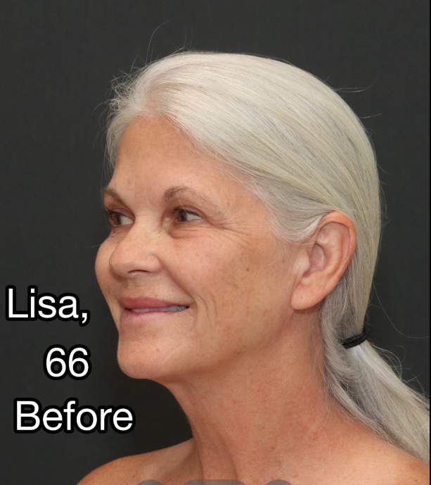 Lisa pose avant les interventions, en date du 3 avril 2025 | Source : TikTok/@nayakplasticsurgery