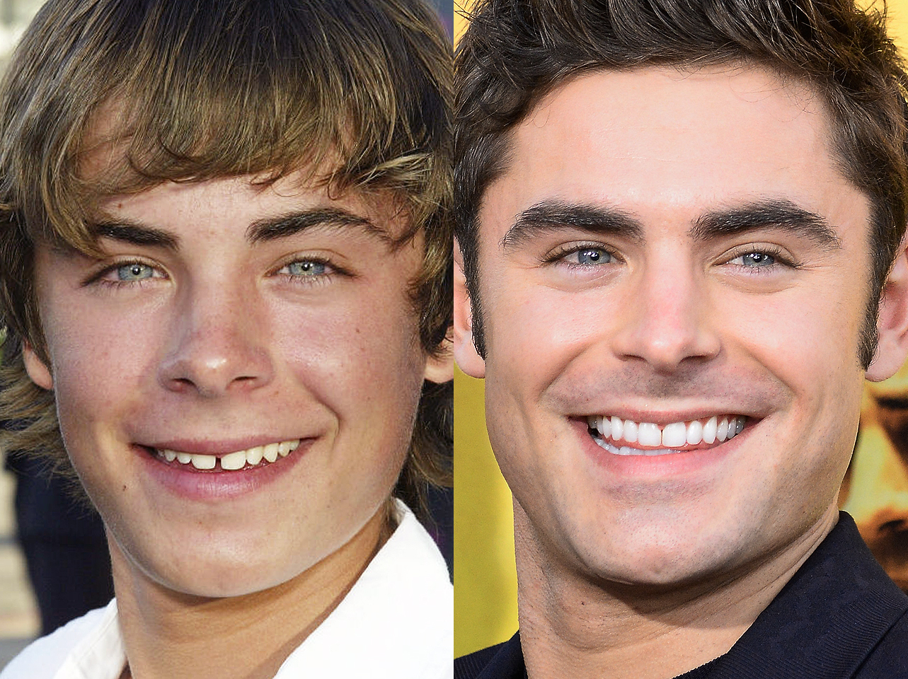 Avant et après du sourire de Zac Efron. | Source : Getty Images