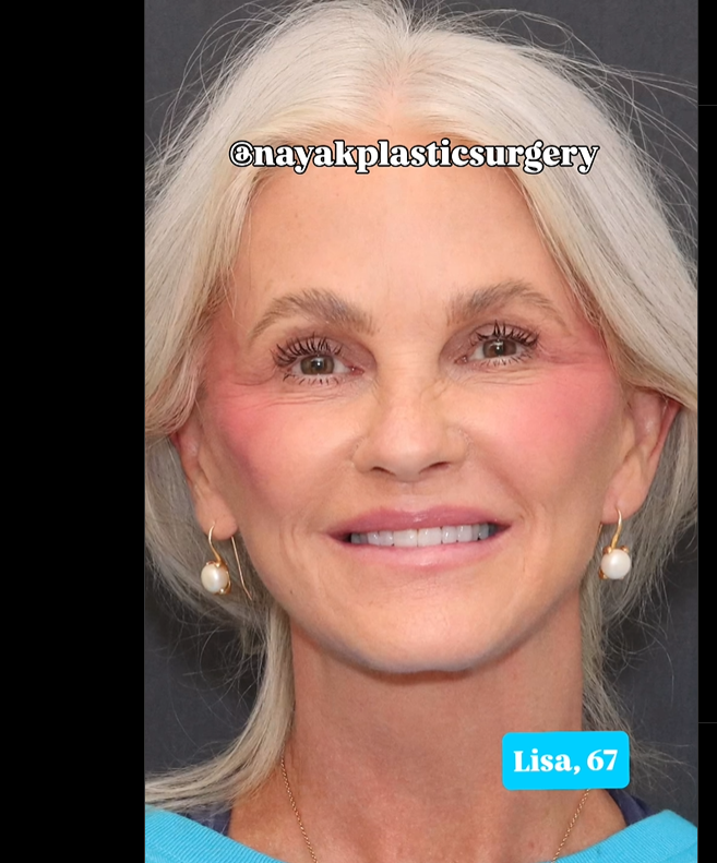 Lisa sourit à l'appareil photo, en post-opératoire, vue dans un post daté du 1er juin 2025 | Source : Instagram/nayakplasticsurgery