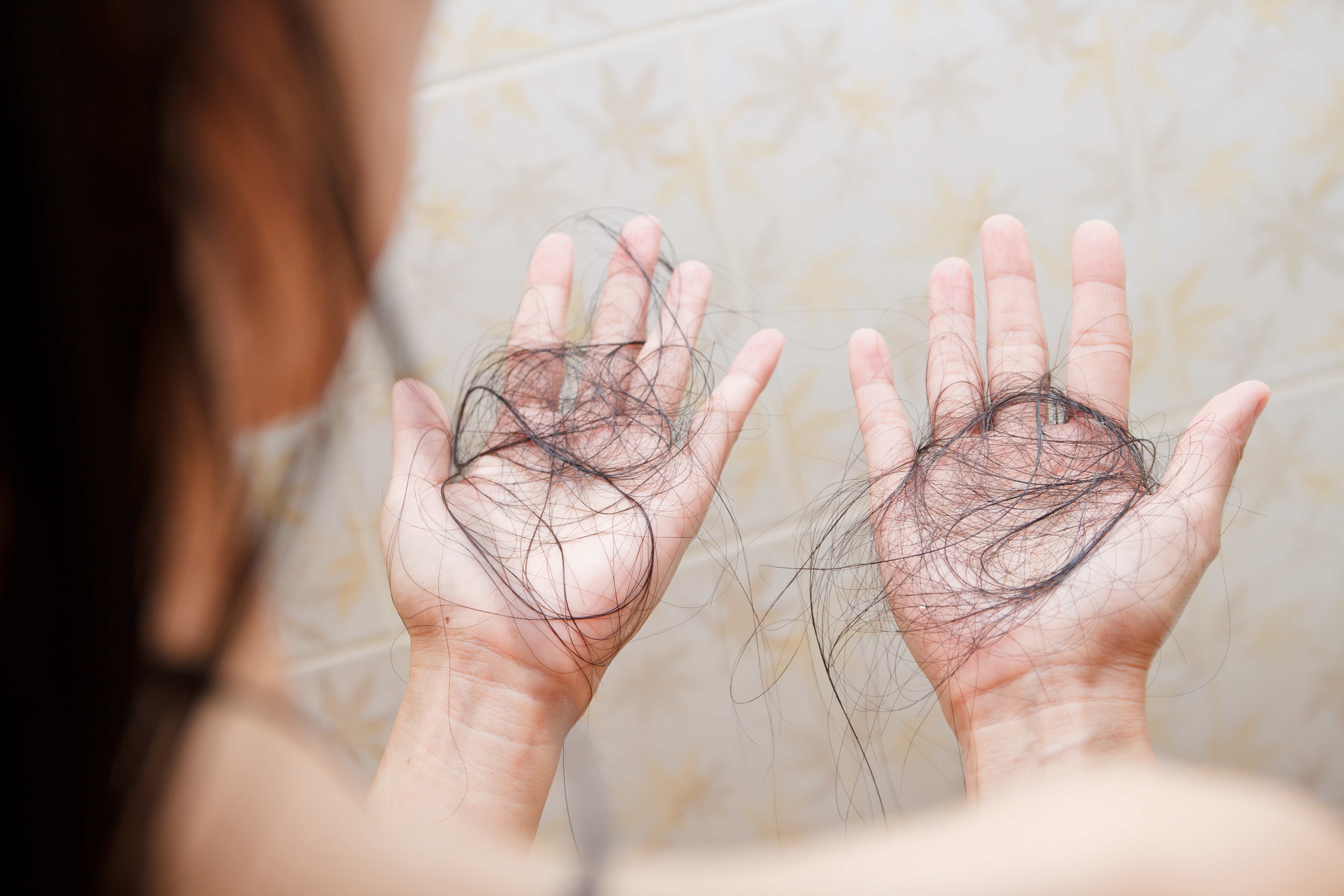 Une personne qui perd ses cheveux | Source : Shutterstock