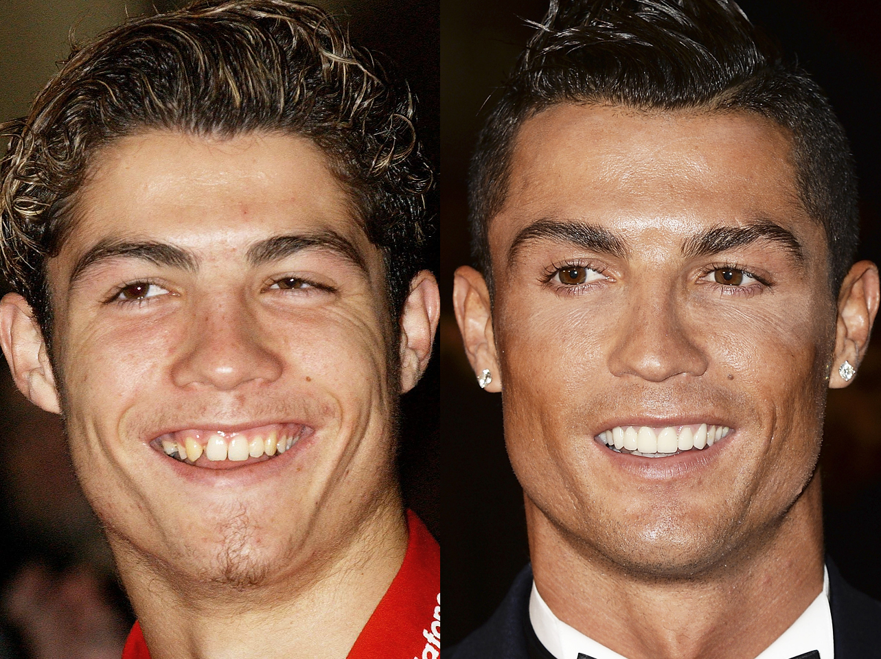 Avant et après du sourire de Cristiano Ronaldo. | Source : Getty Images