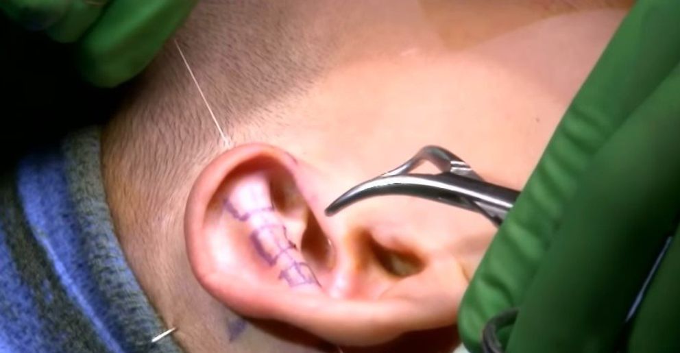 Photo de l'oreille de Gage pendant l'opération. | Source : Youtube/Inside Edition