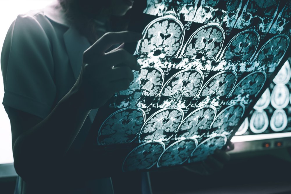 La maladie d'Alzheimer à l'IRM. | Source : Shutterstock