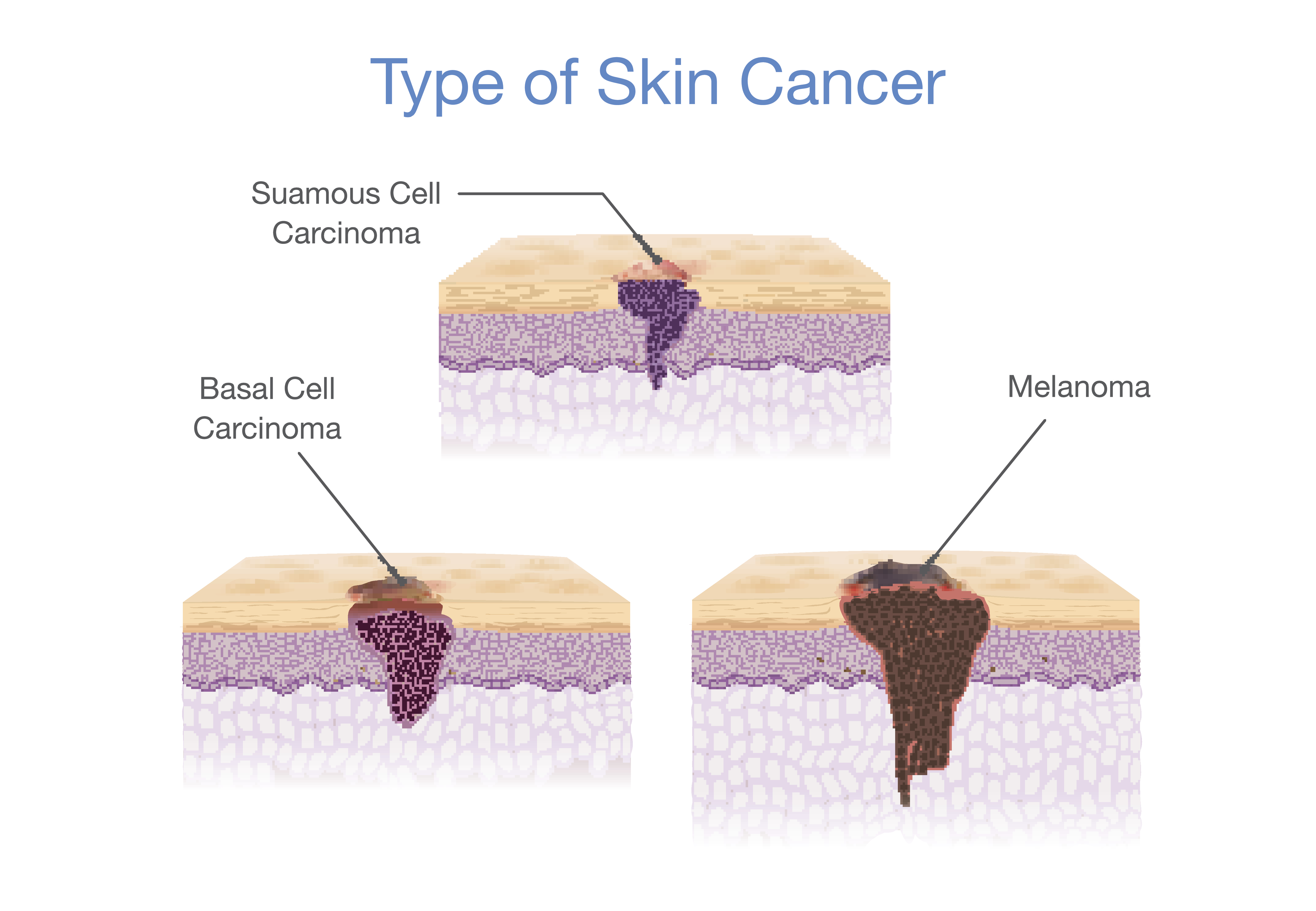 Types de cancer de la peau illustrés dans un style vectoriel 3D Représentation médicale | Source : Getty Images