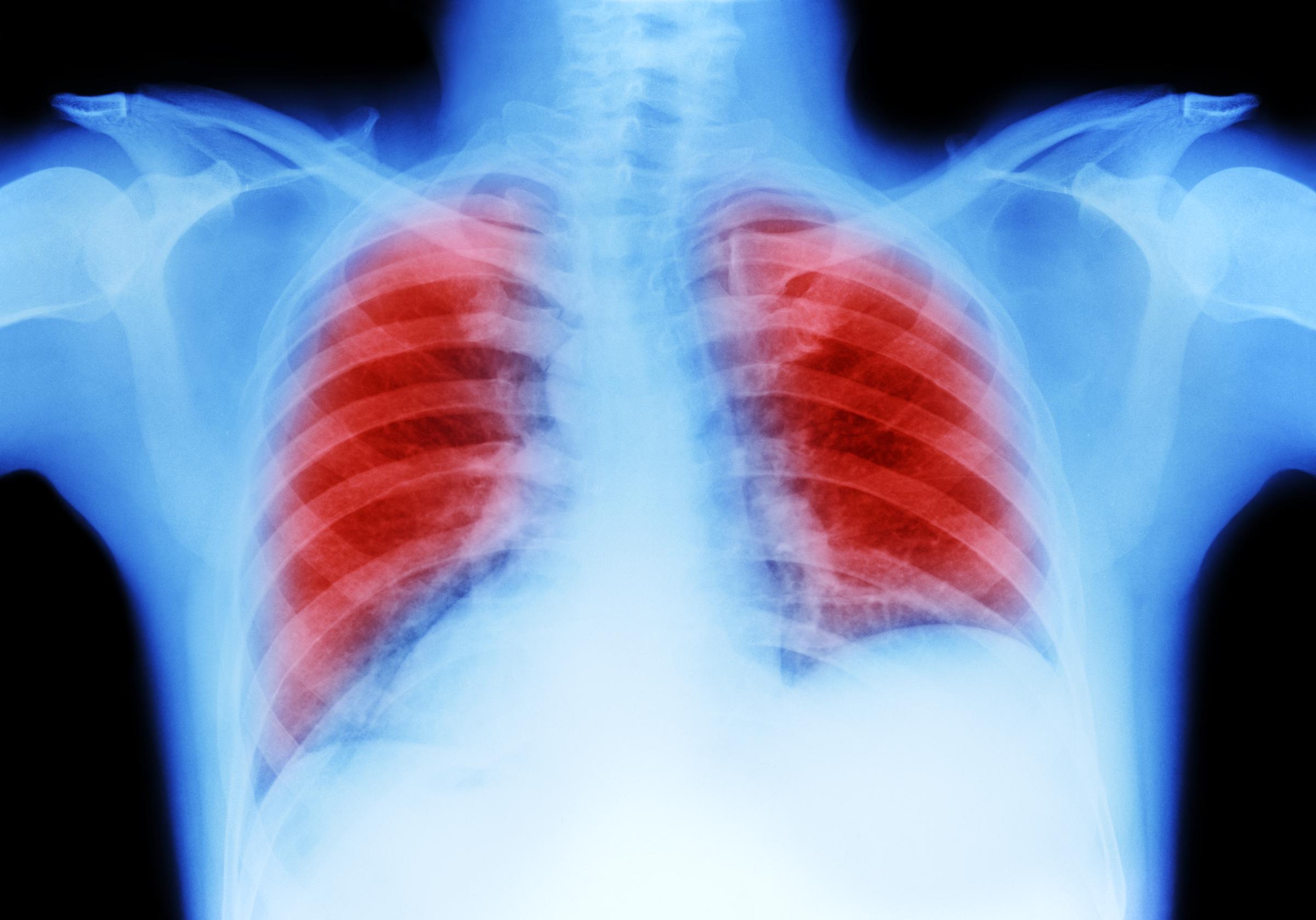 Une radiographie des poumons | Source : Getty Images