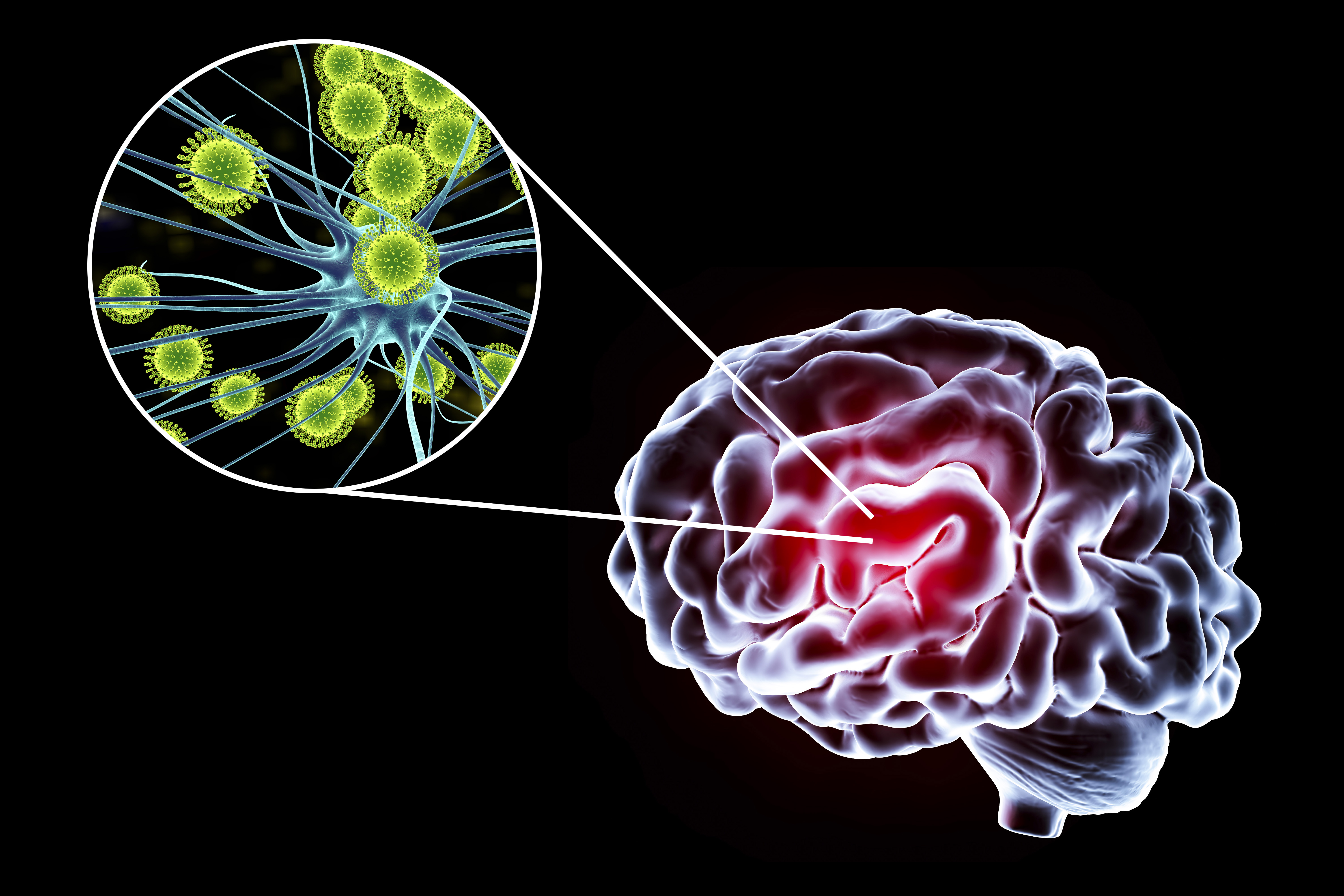 Illustration conceptuelle montrant le cerveau et une vue rapprochée de virus infectant les neurones | Source : Getty images