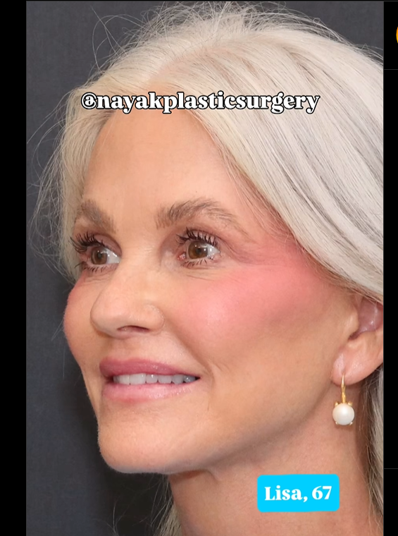 Lisa après l'opération, comme on peut le voir dans un post daté du 1er juin 2025 | Source : Instagram/nayakplasticsurgery